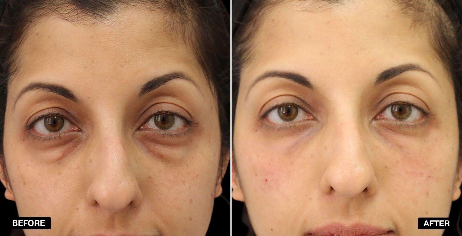 Dark Circles Transformations - patient case 1 of 1 at PHI Clinic London