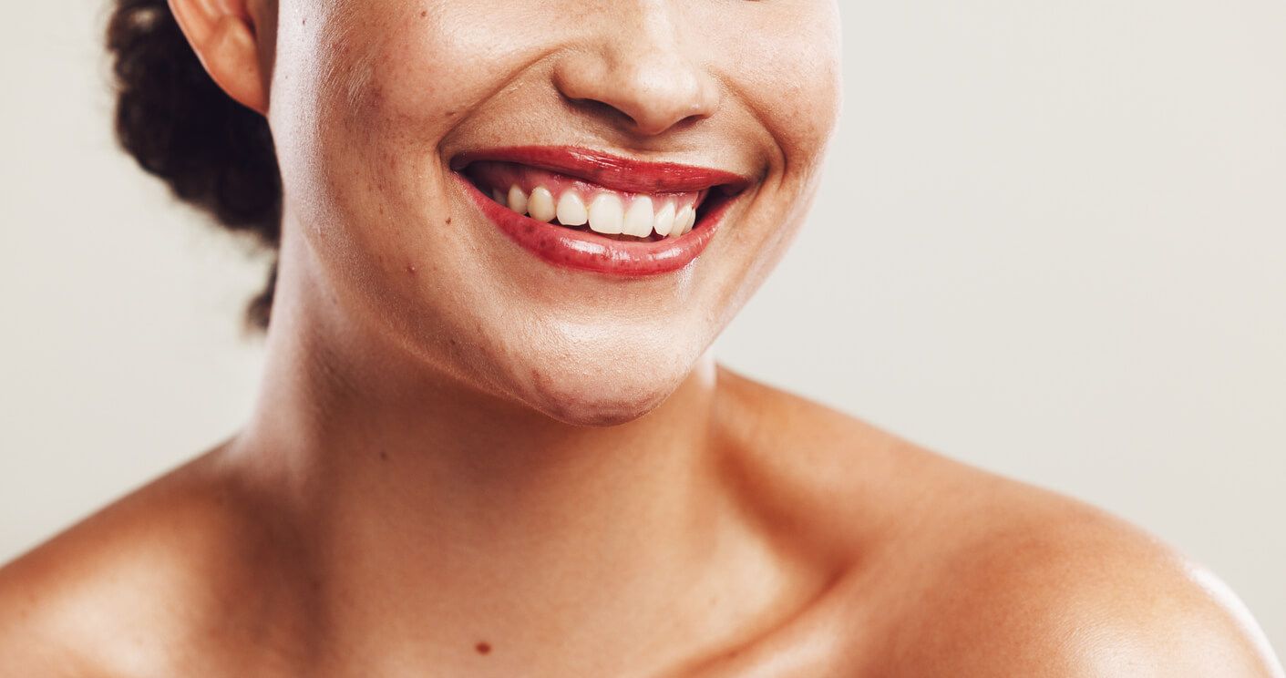 do you need filler for smile lines
