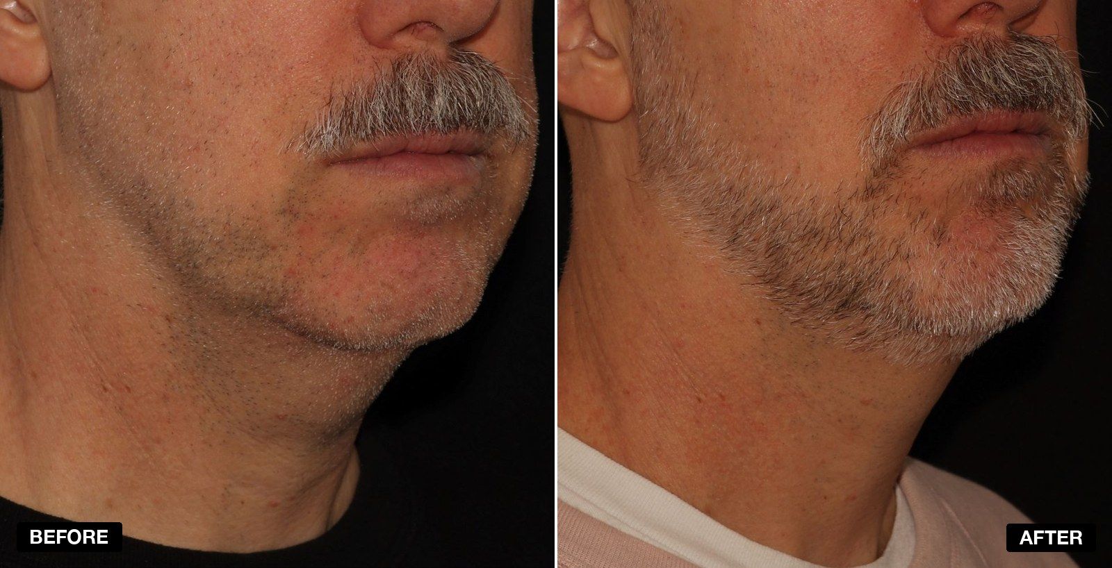 Double chin treatment before and after - patient case 1 of 4 at PHI Clinic London