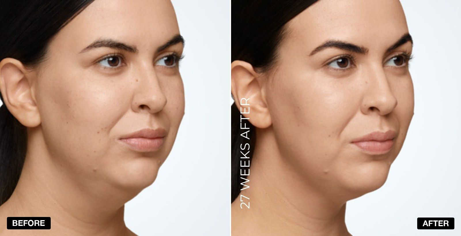 Double chin treatment before and after - patient case 3 of 4 at PHI Clinic London