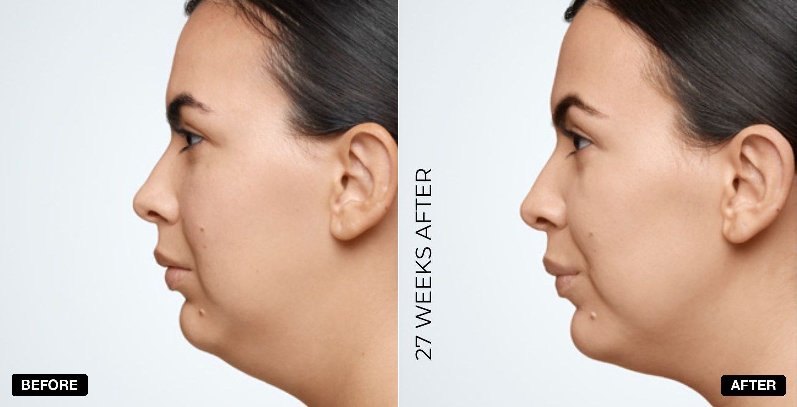 Double chin treatment before and after - patient case 4 of 4 at PHI Clinic London