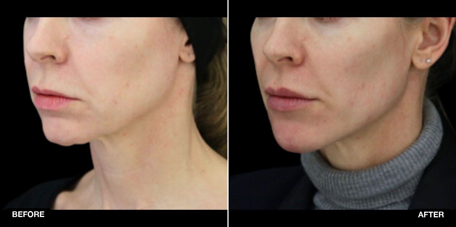 Drooping Mouth Corner transformations - patient case 1 of 1 at PHI Clinic London