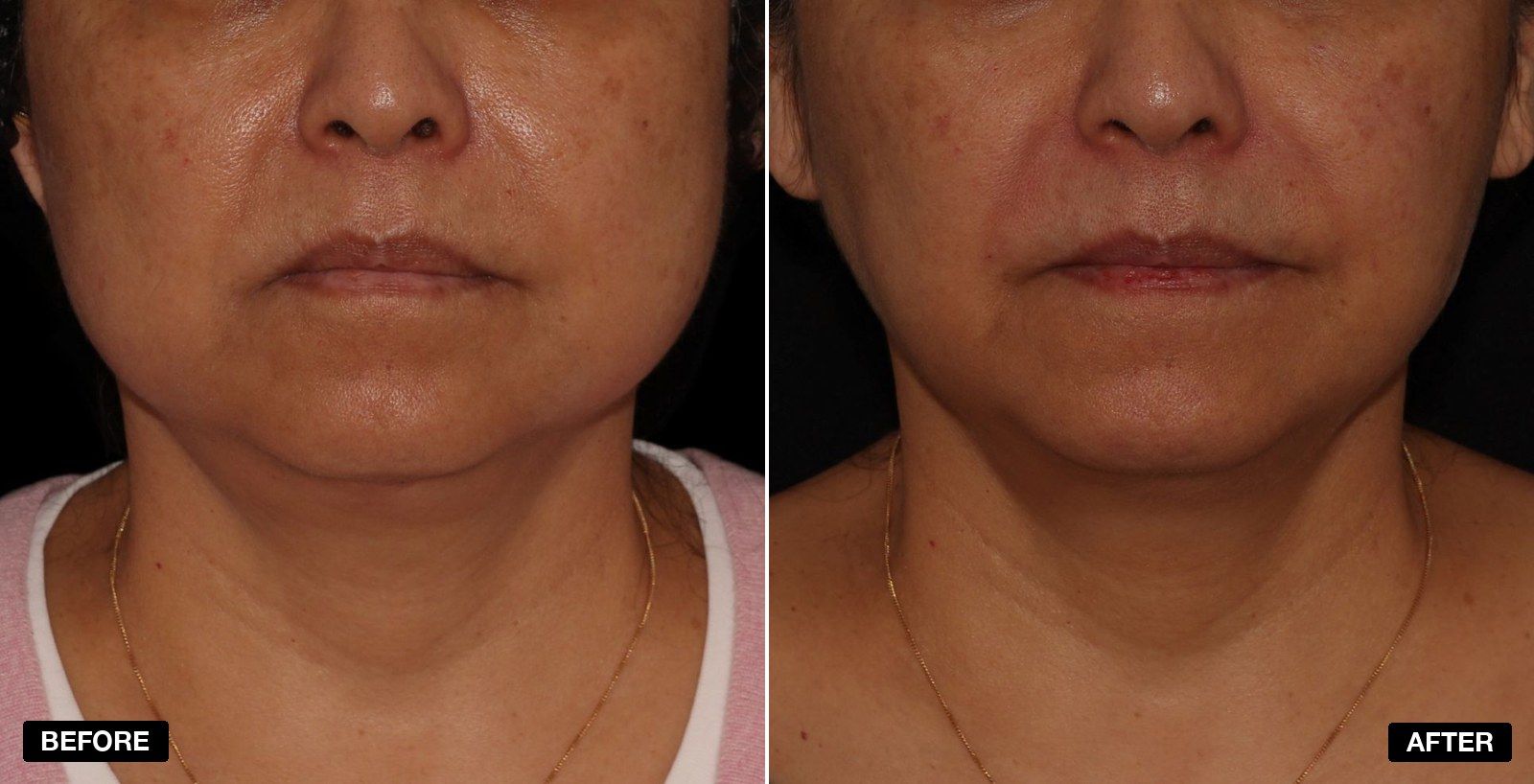 Endolift before & afters - patient case 1 of 6 at PHI Clinic London