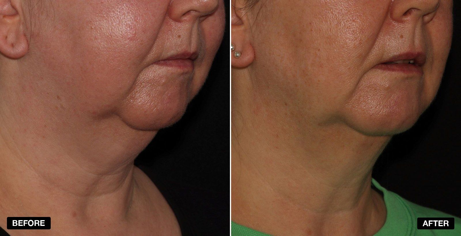 Endolift before & afters - patient case 2 of 6 at PHI Clinic London