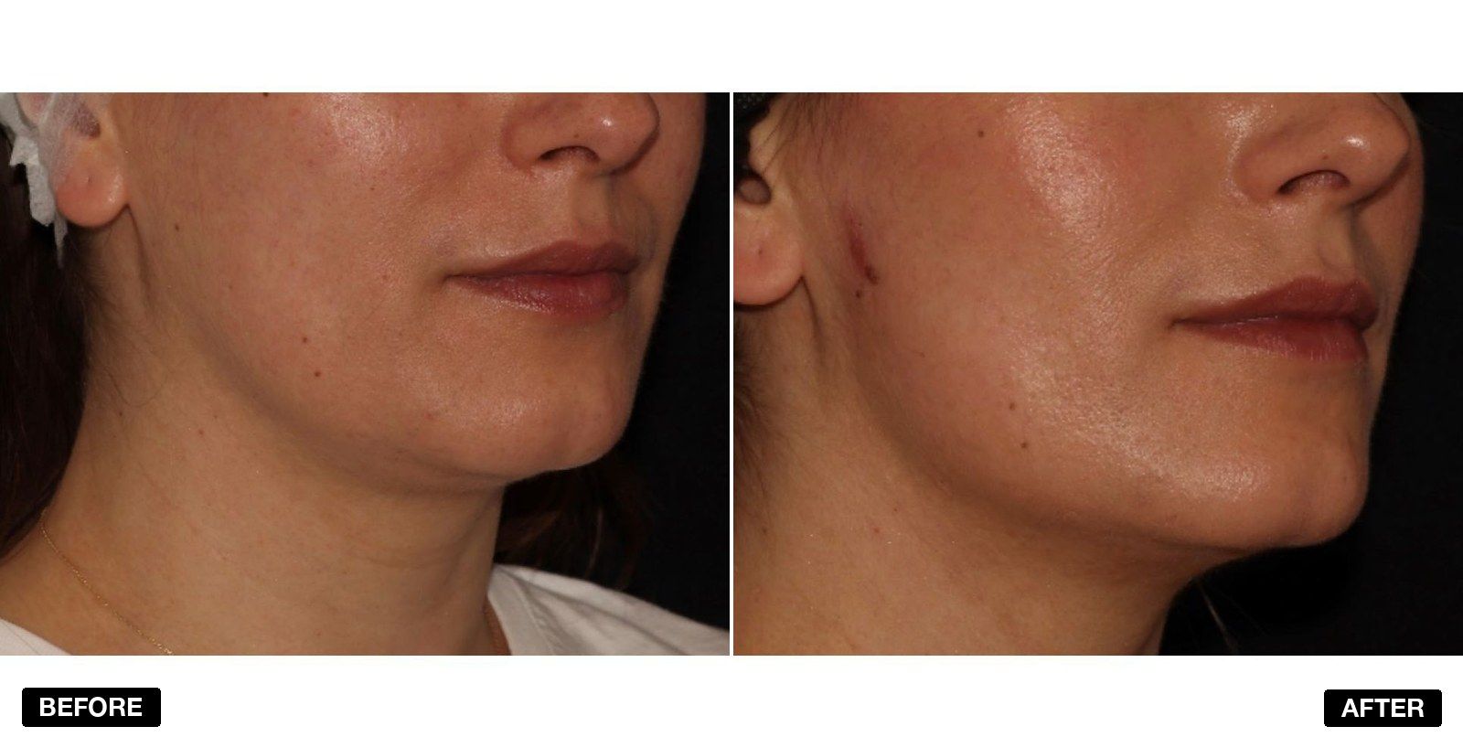 Endolift before & afters - patient case 5 of 6 at PHI Clinic London