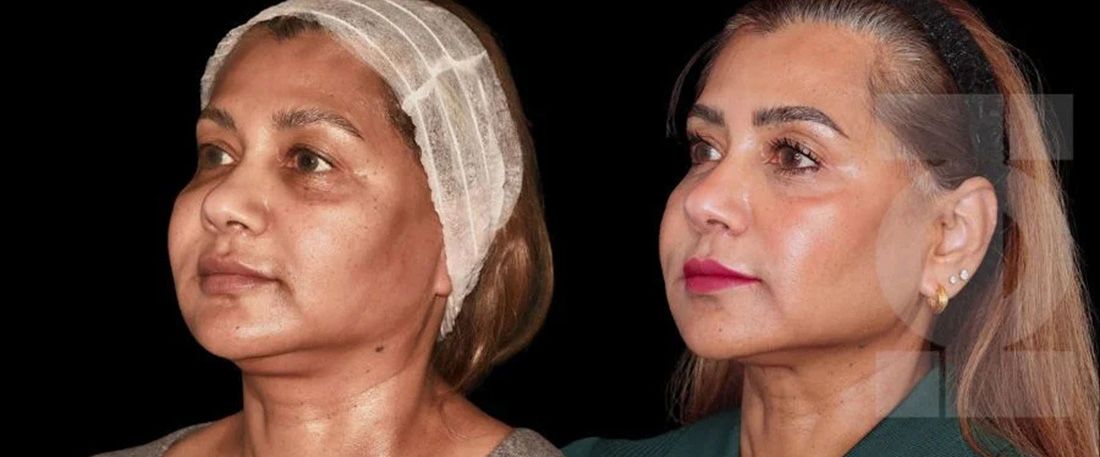 Endolift before and after
