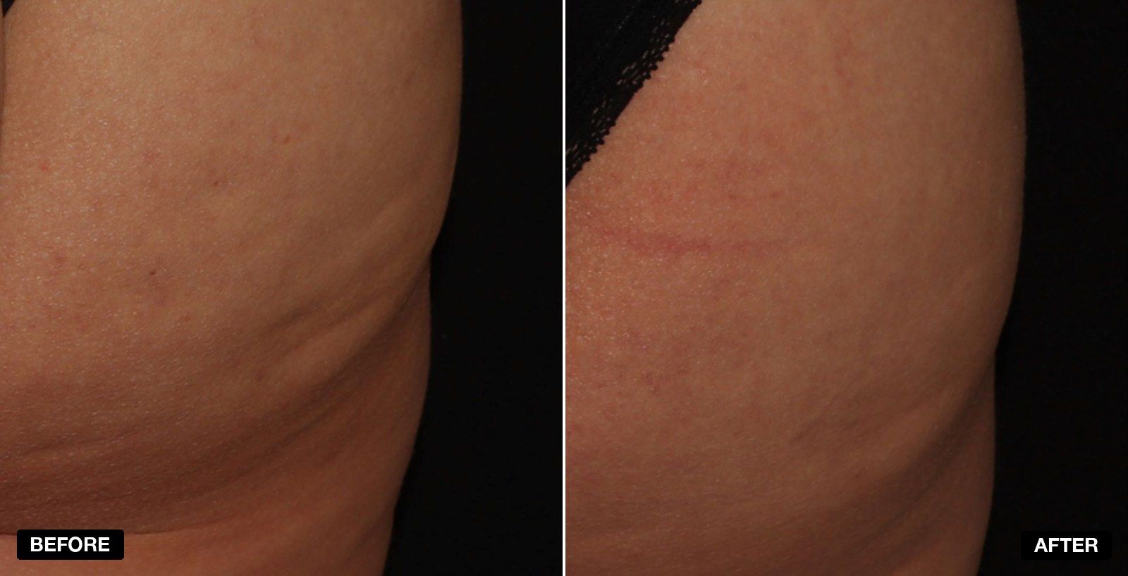 Endolift transformation - patient case 1 of 1 at PHI Clinic London