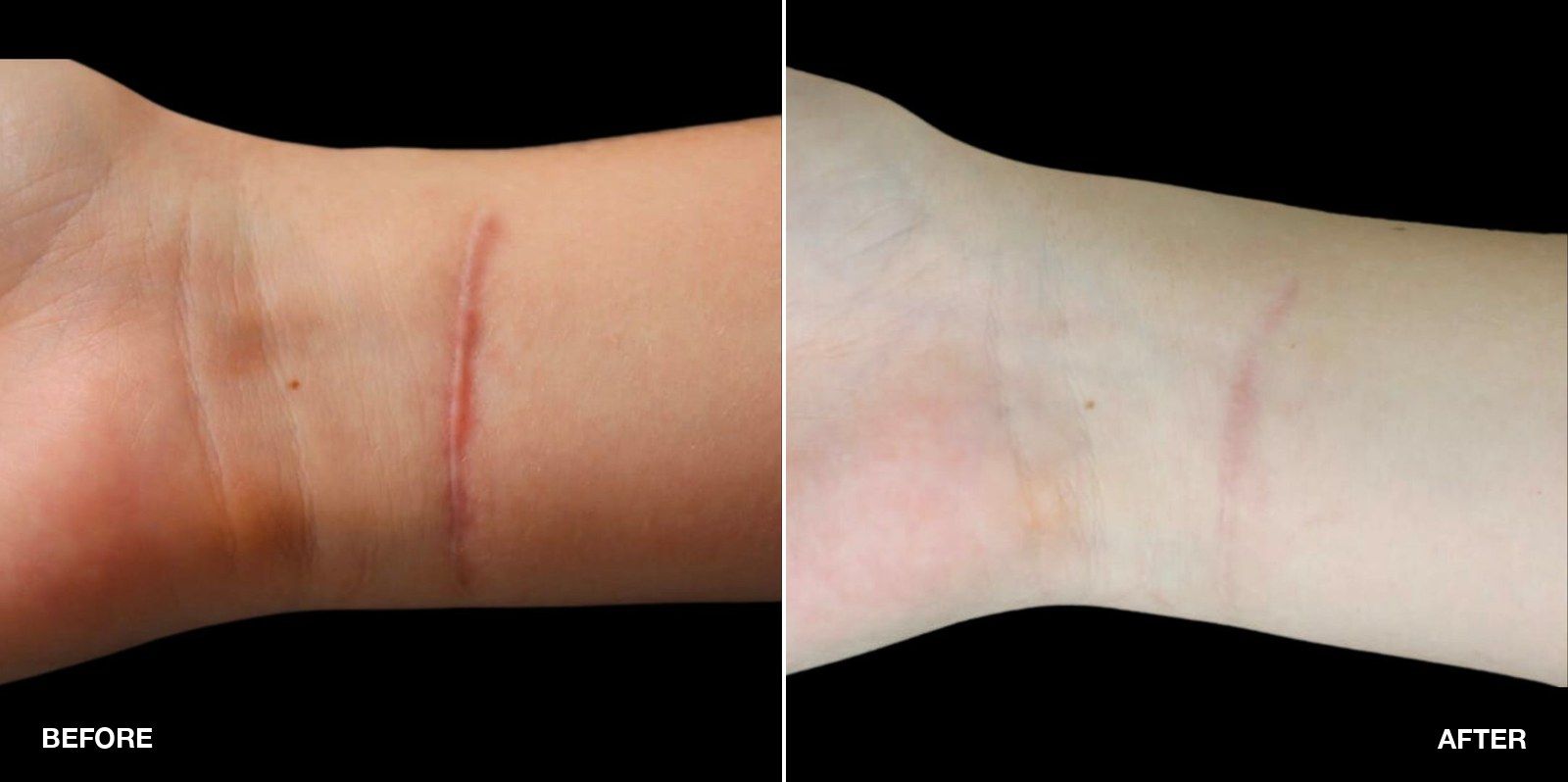 Erbium YAG Laser transformations - patient case 1 of 1 at PHI Clinic London