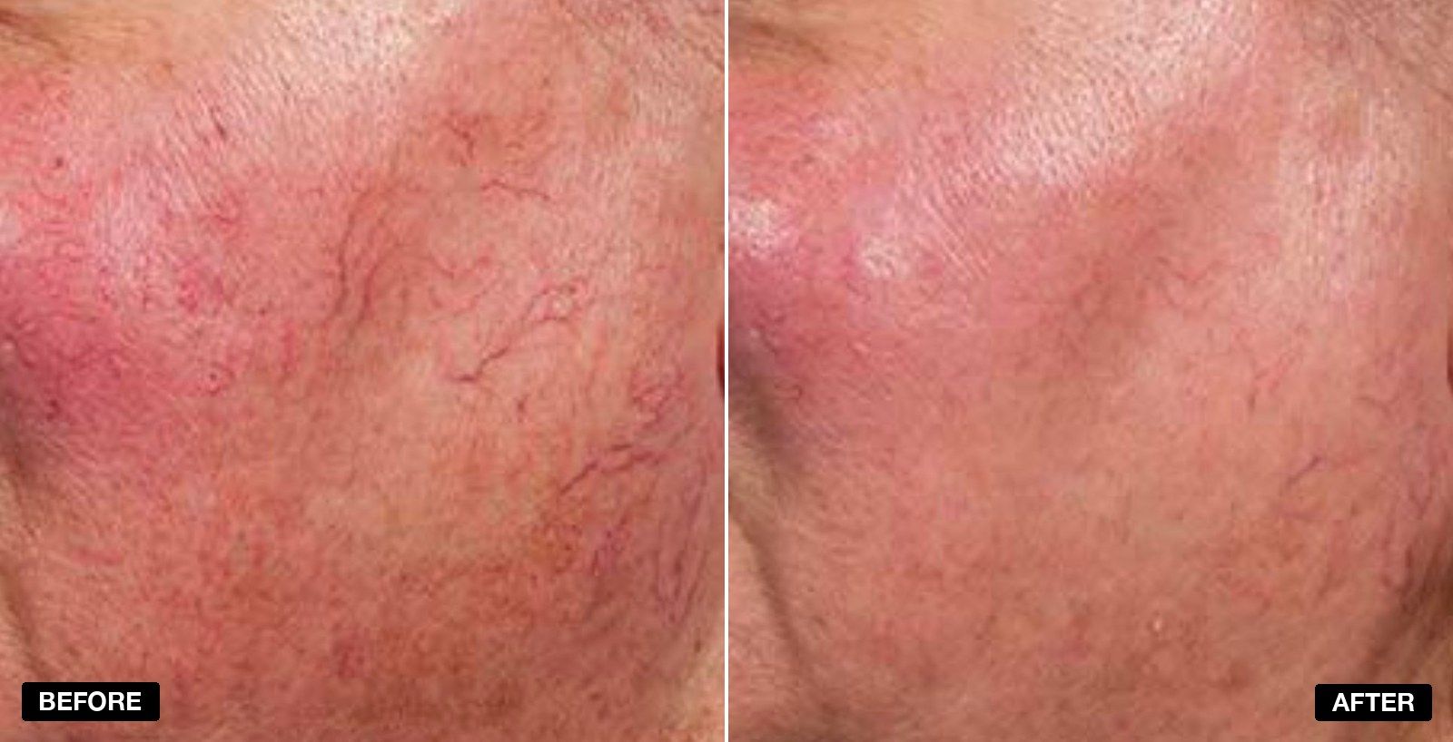 excel V+ transformations - patient case 1 of 5 at PHI Clinic London