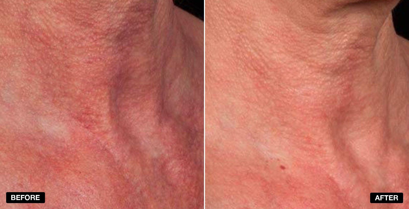 excel V+ transformations - patient case 2 of 5 at PHI Clinic London