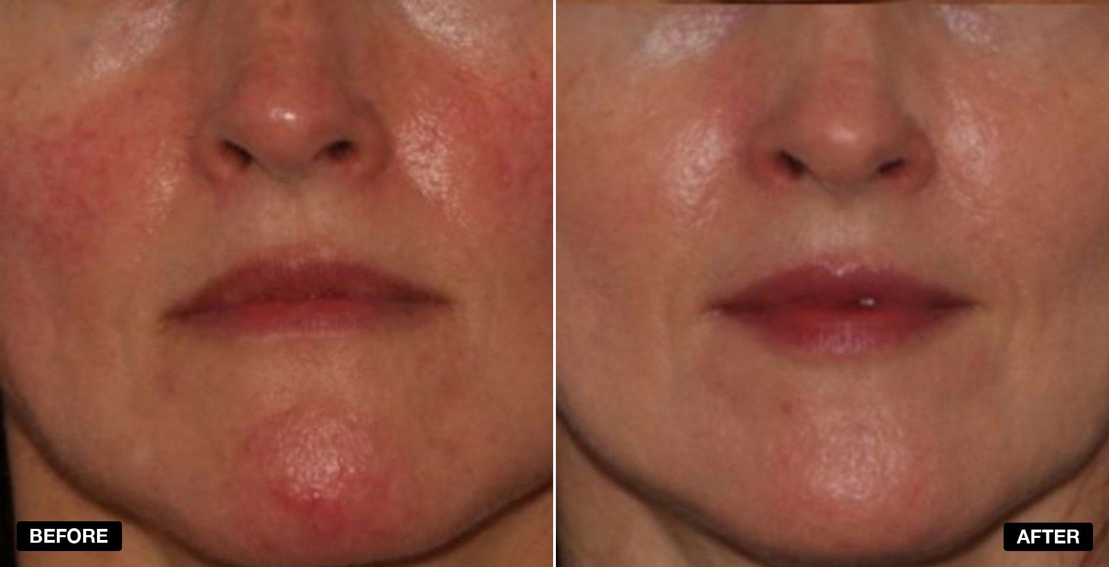 excel V+ transformations - patient case 3 of 5 at PHI Clinic London