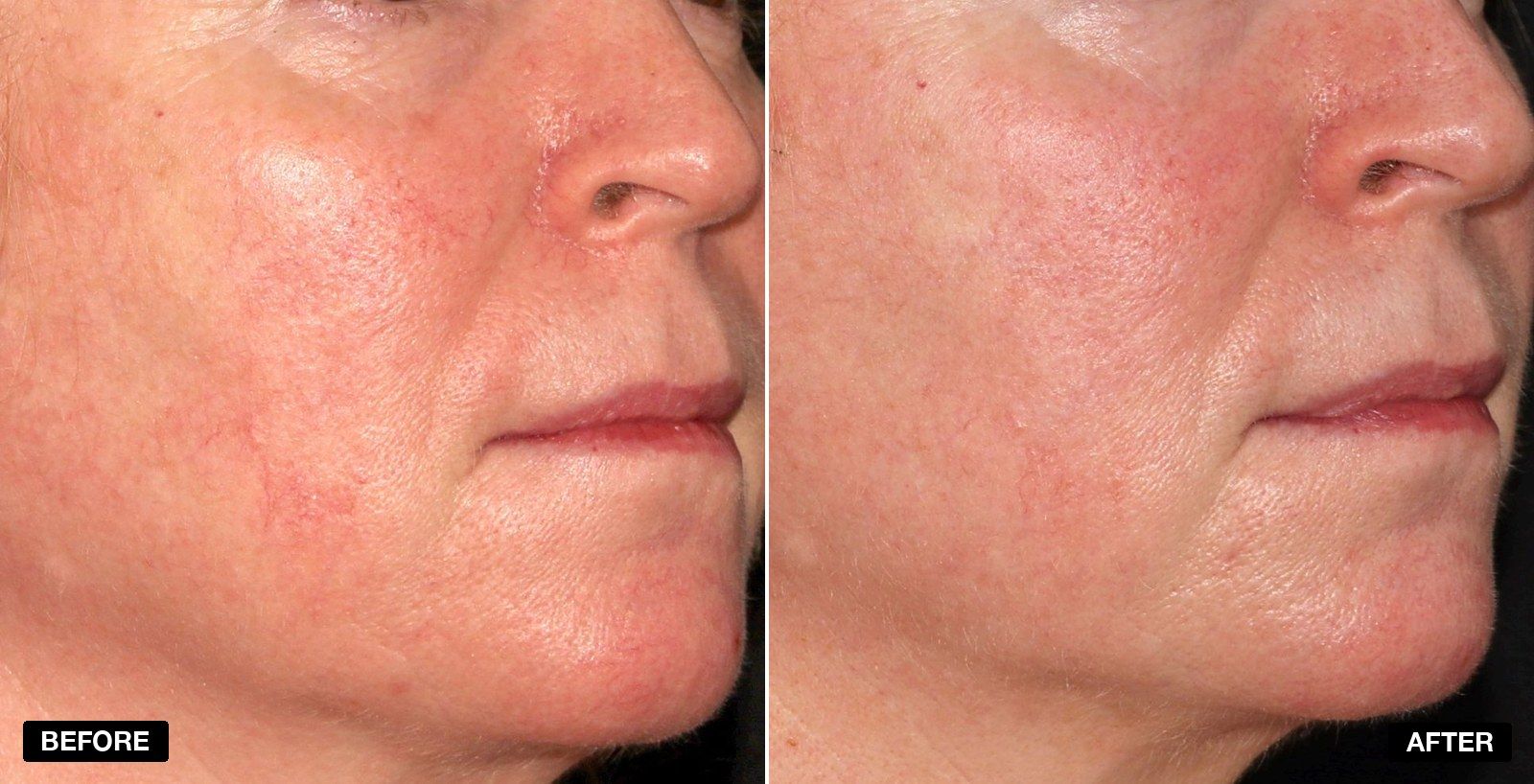 excel V+ transformations - patient case 4 of 5 at PHI Clinic London