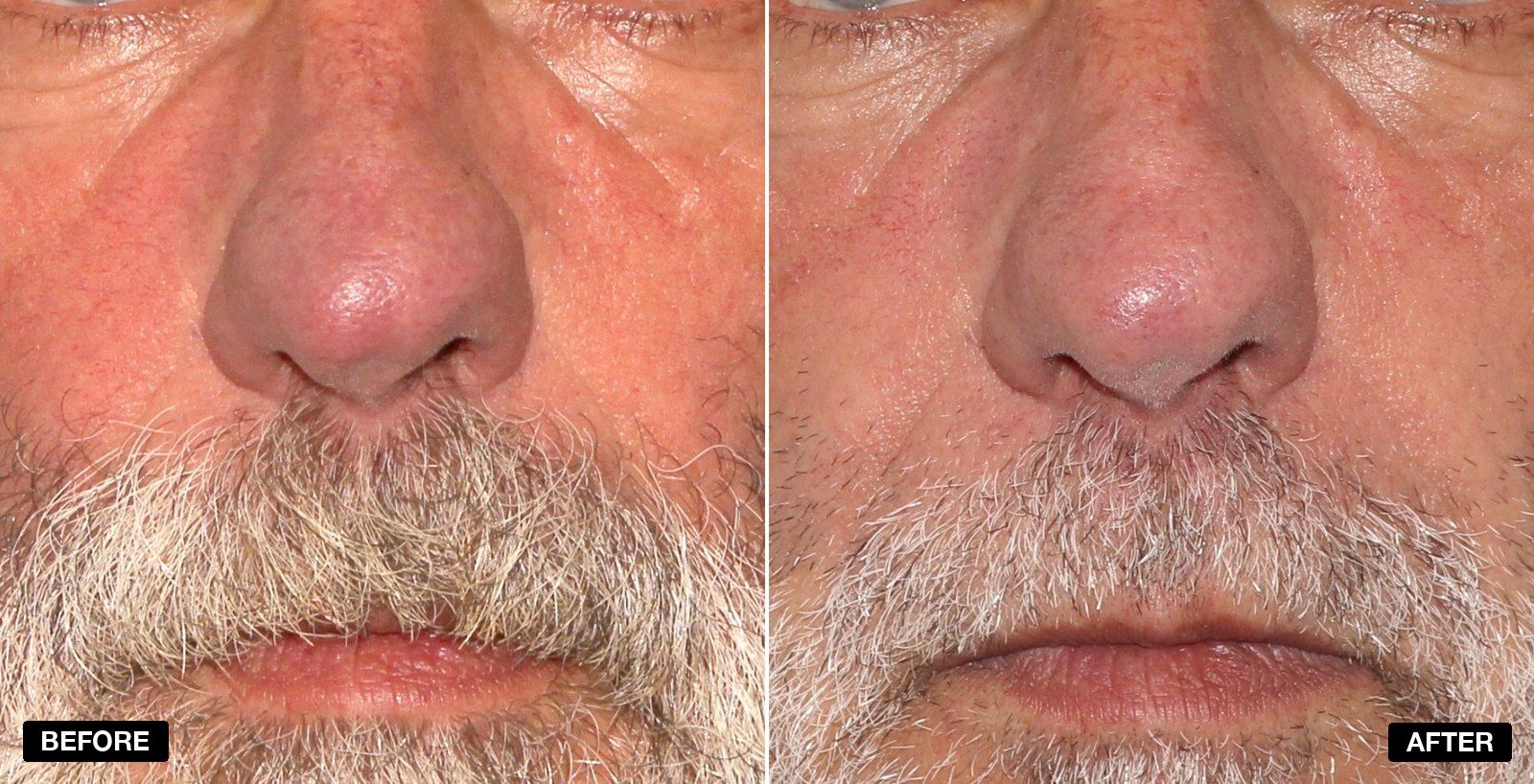 excel V+ transformations - patient case 5 of 5 at PHI Clinic London