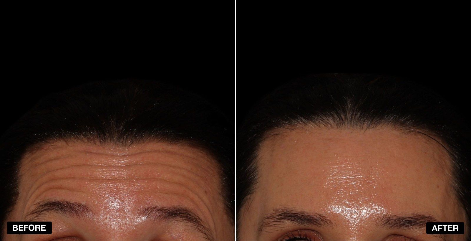 Forehead lines transformations - patient case 1 of 1 at PHI Clinic London
