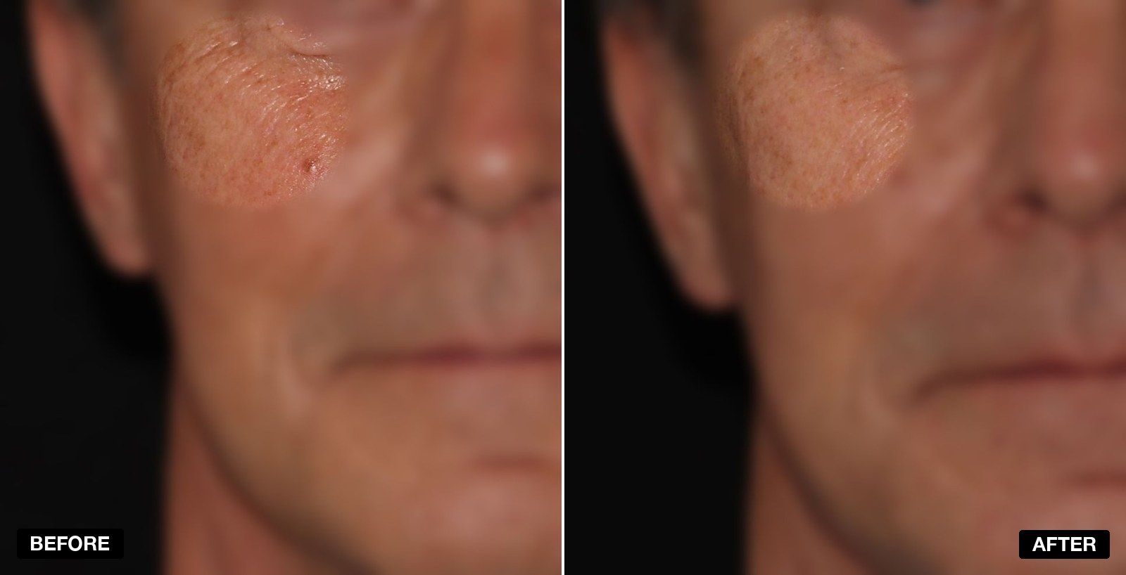 GenTix GF transformations - patient case 1 of 1 at PHI Clinic London