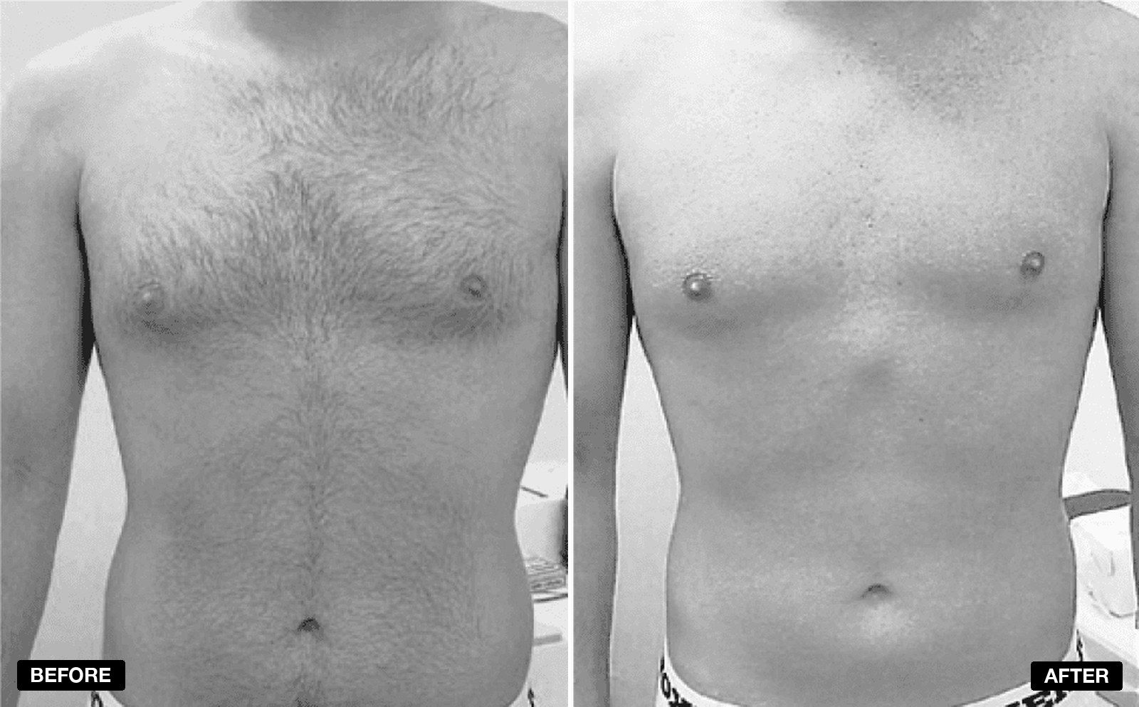 Gentlemax Pro transformations - patient case 1 of 1 at PHI Clinic London
