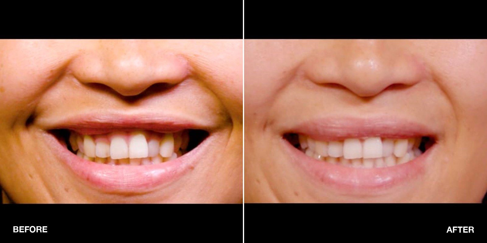 Gummy Smile transformations - patient case 1 of 2 at PHI Clinic London