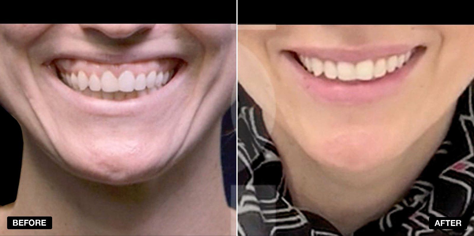 Gummy Smile transformations - patient case 2 of 2 at PHI Clinic London