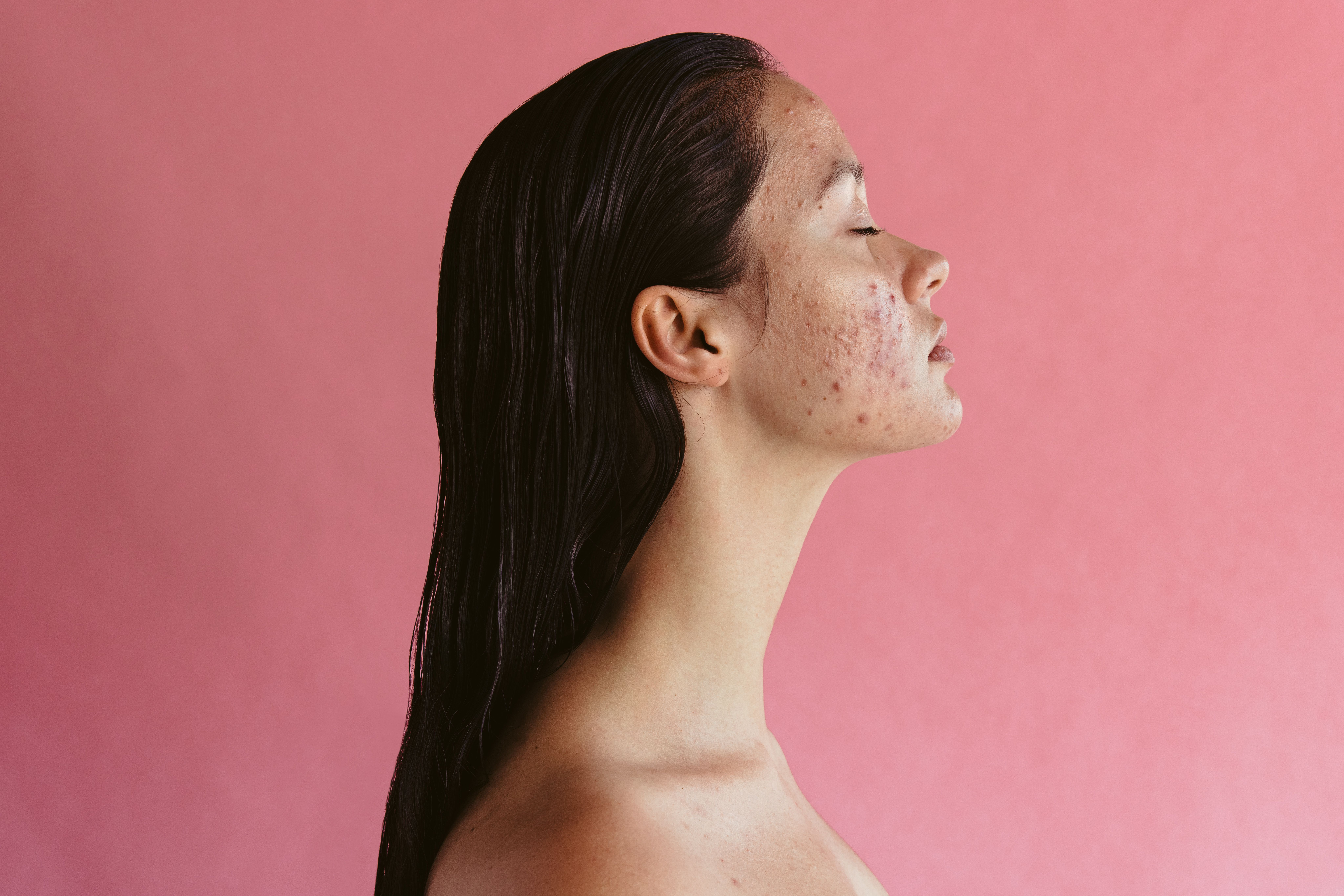 Acne Image