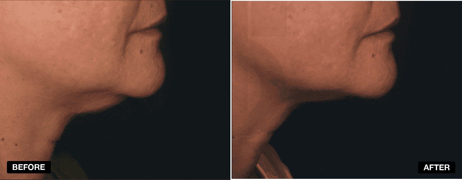 INFINI treatment transformation - patient case 1 of 1 at PHI Clinic London