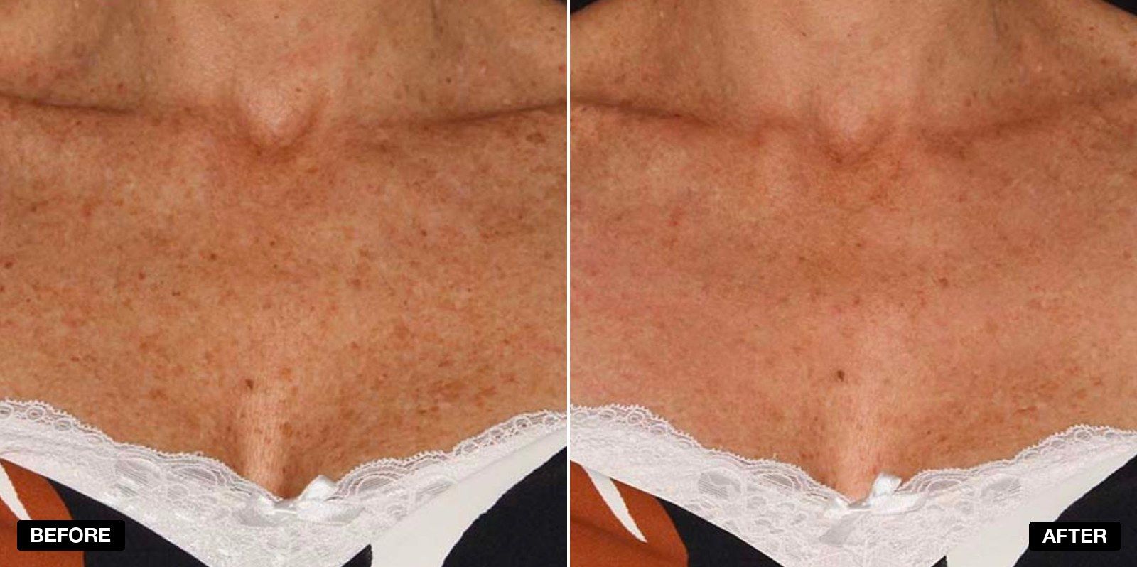 IPL treatment transformation - patient case 1 of 1 at PHI Clinic London