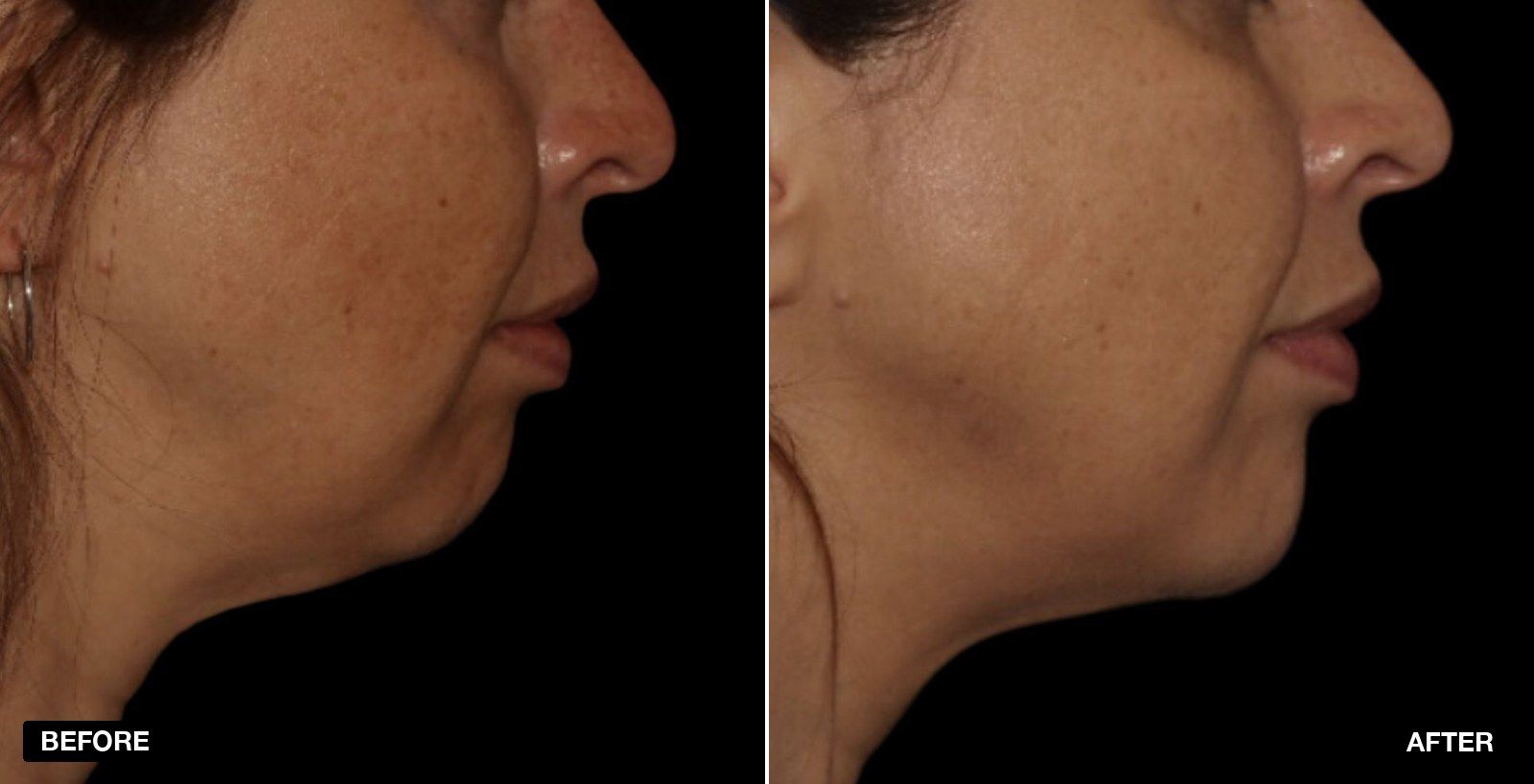 Jawline filler before and after images - patient case 1 of 7 at PHI Clinic London