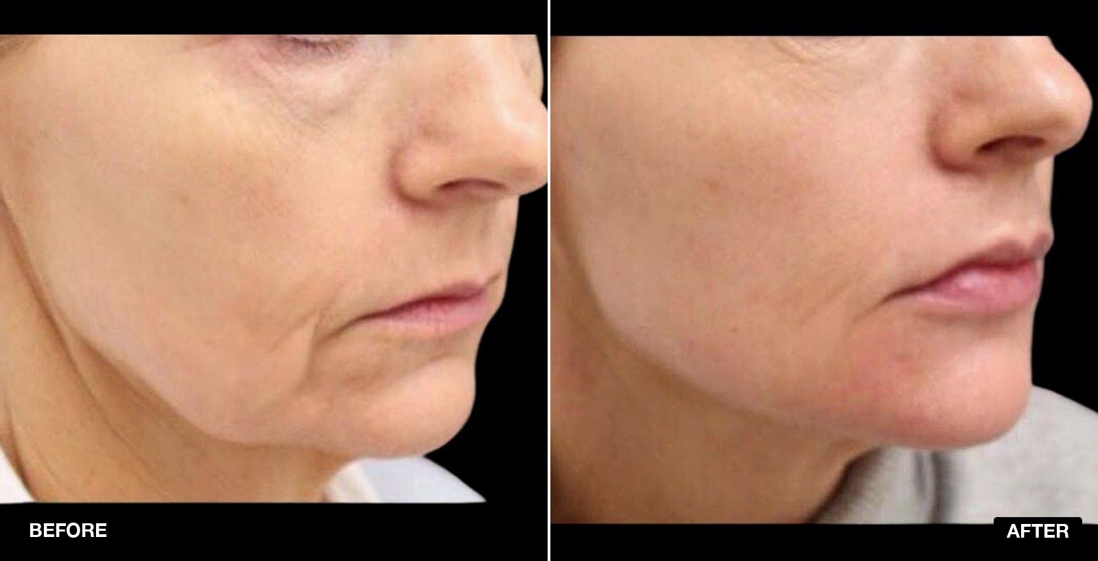 Jawline filler before and after images - patient case 2 of 7 at PHI Clinic London
