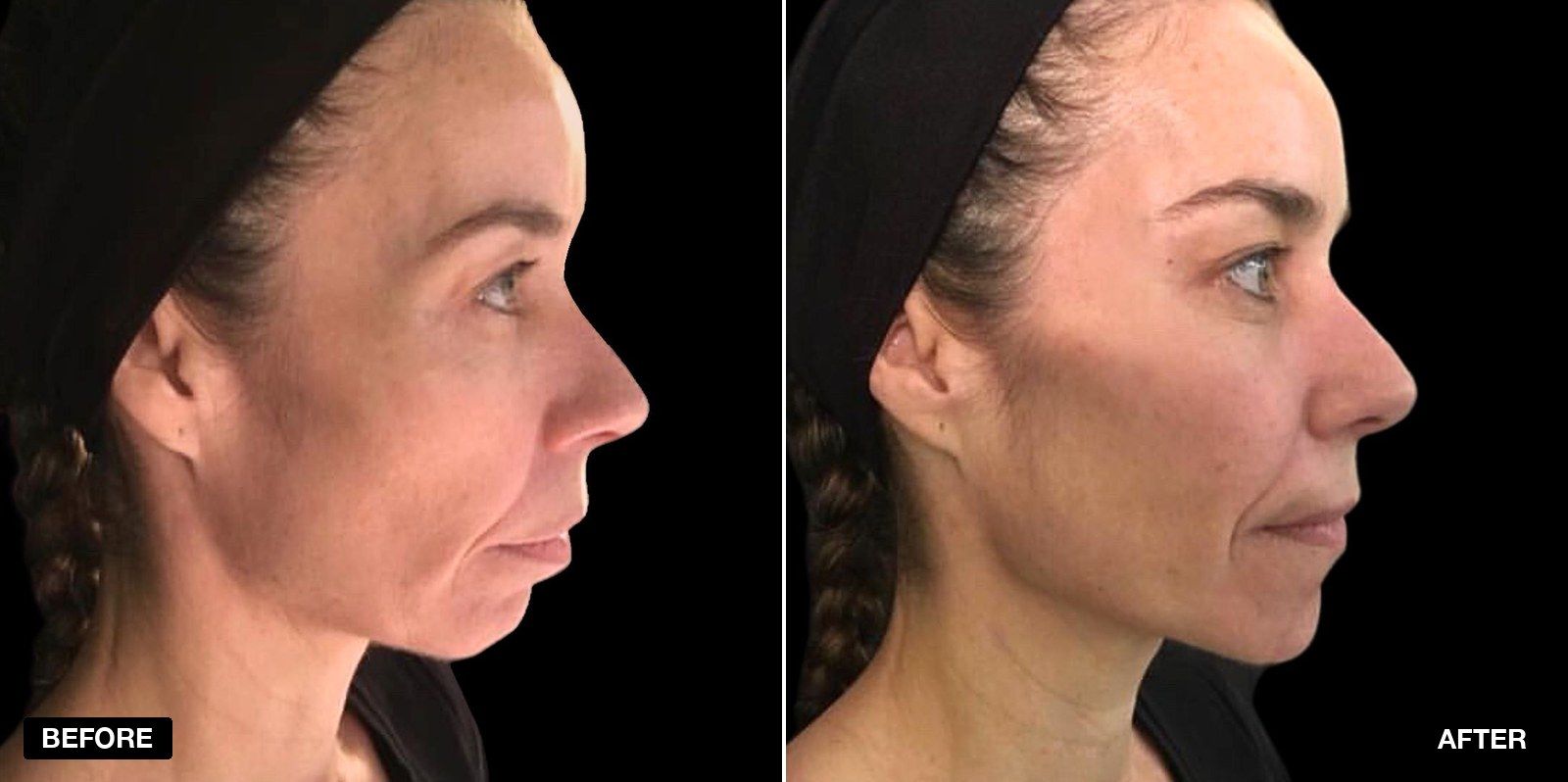 Jawline filler before and after images - patient case 4 of 7 at PHI Clinic London