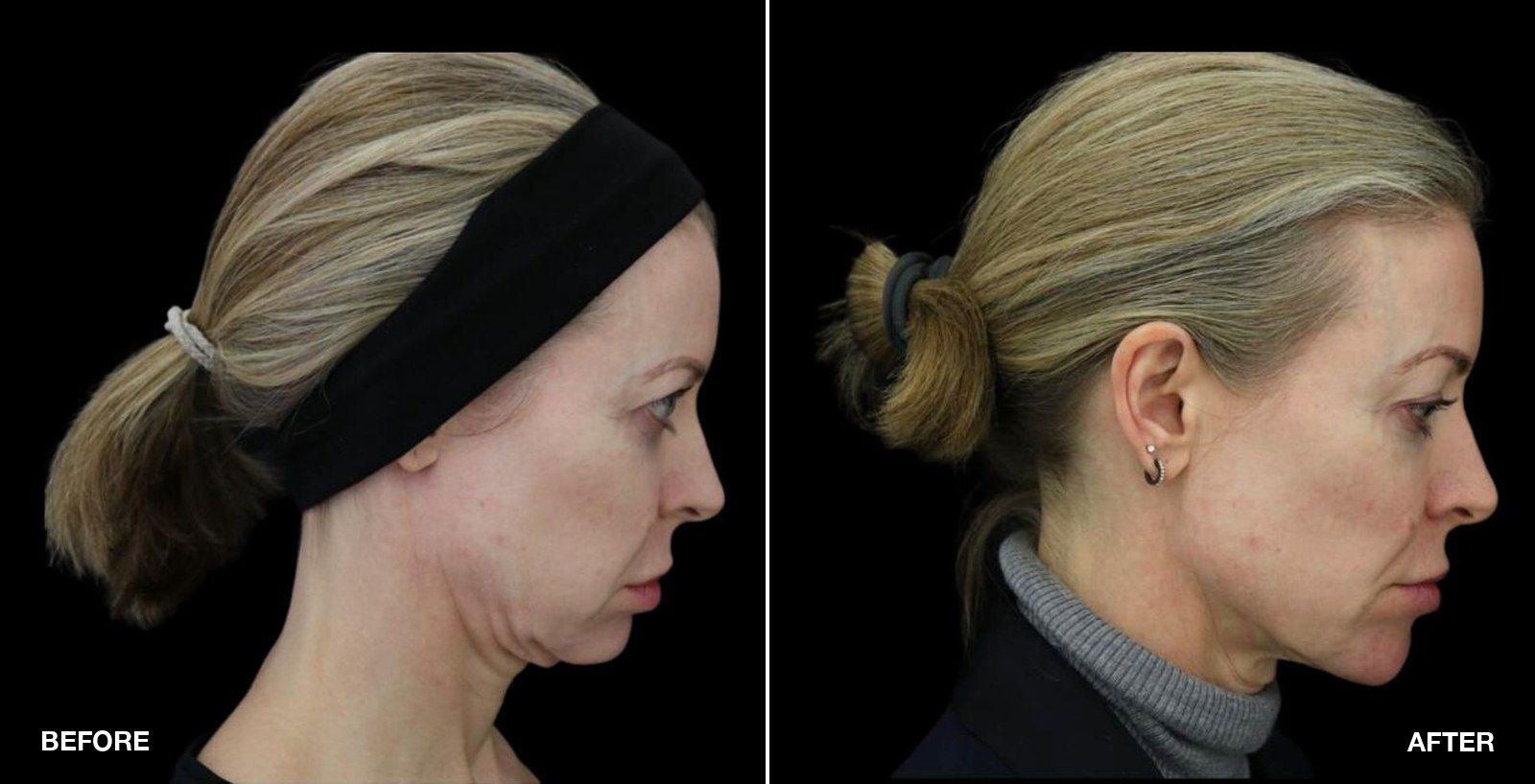 Jawline filler before and after images - patient case 6 of 7 at PHI Clinic London