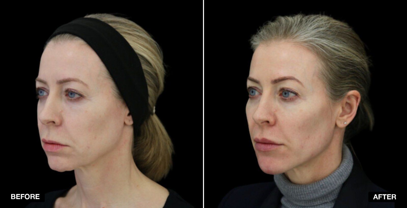 Juvéderm transformations - patient case 1 of 1 at PHI Clinic London
