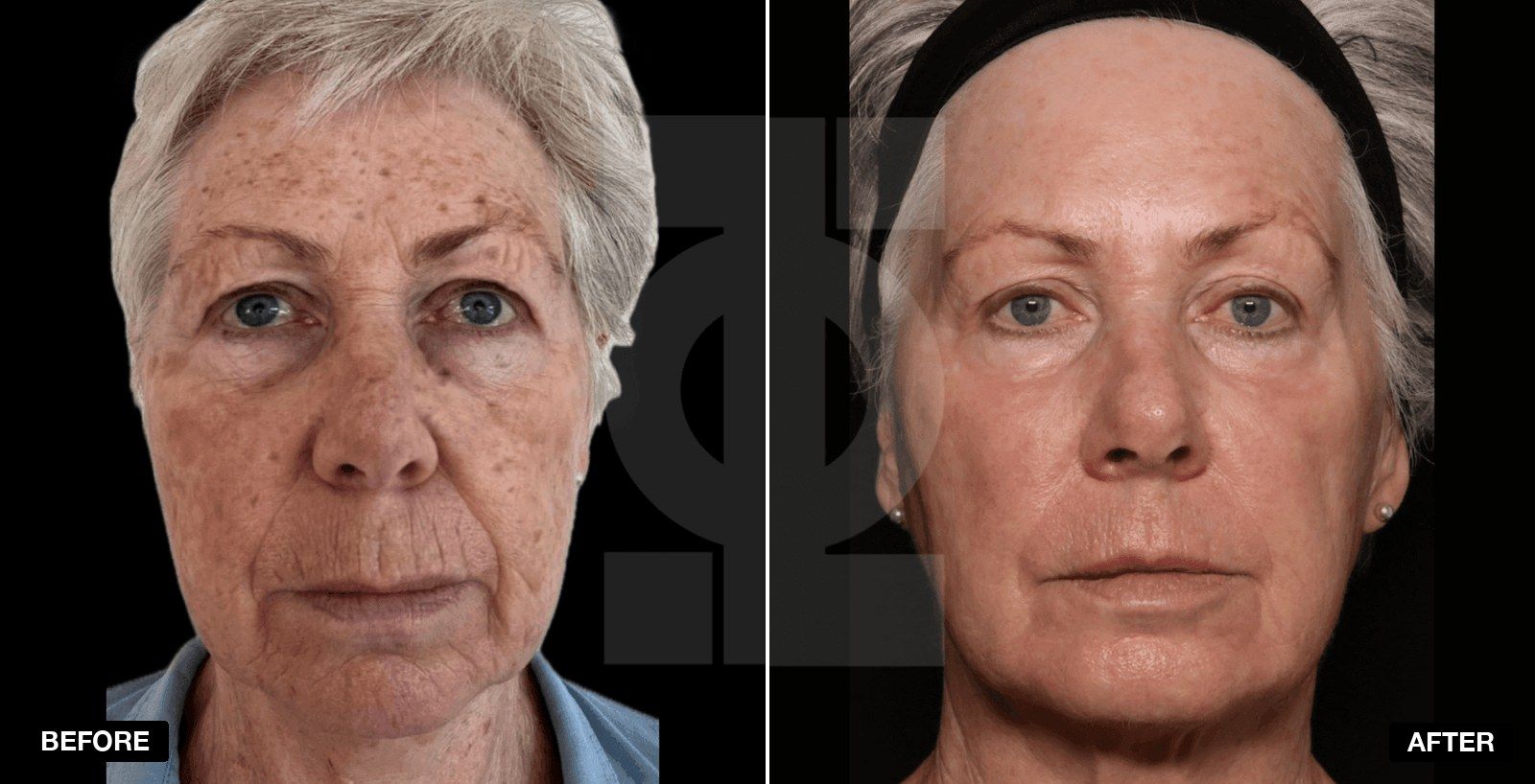 Laser Resurfacing Before & After - patient case 1 of 1 at PHI Clinic London