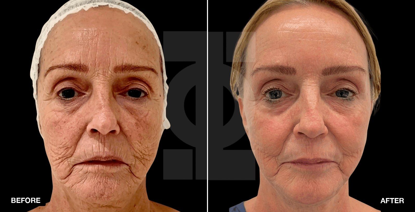 Laser resurfacing before and afters - patient case 1 of 4 at PHI Clinic London