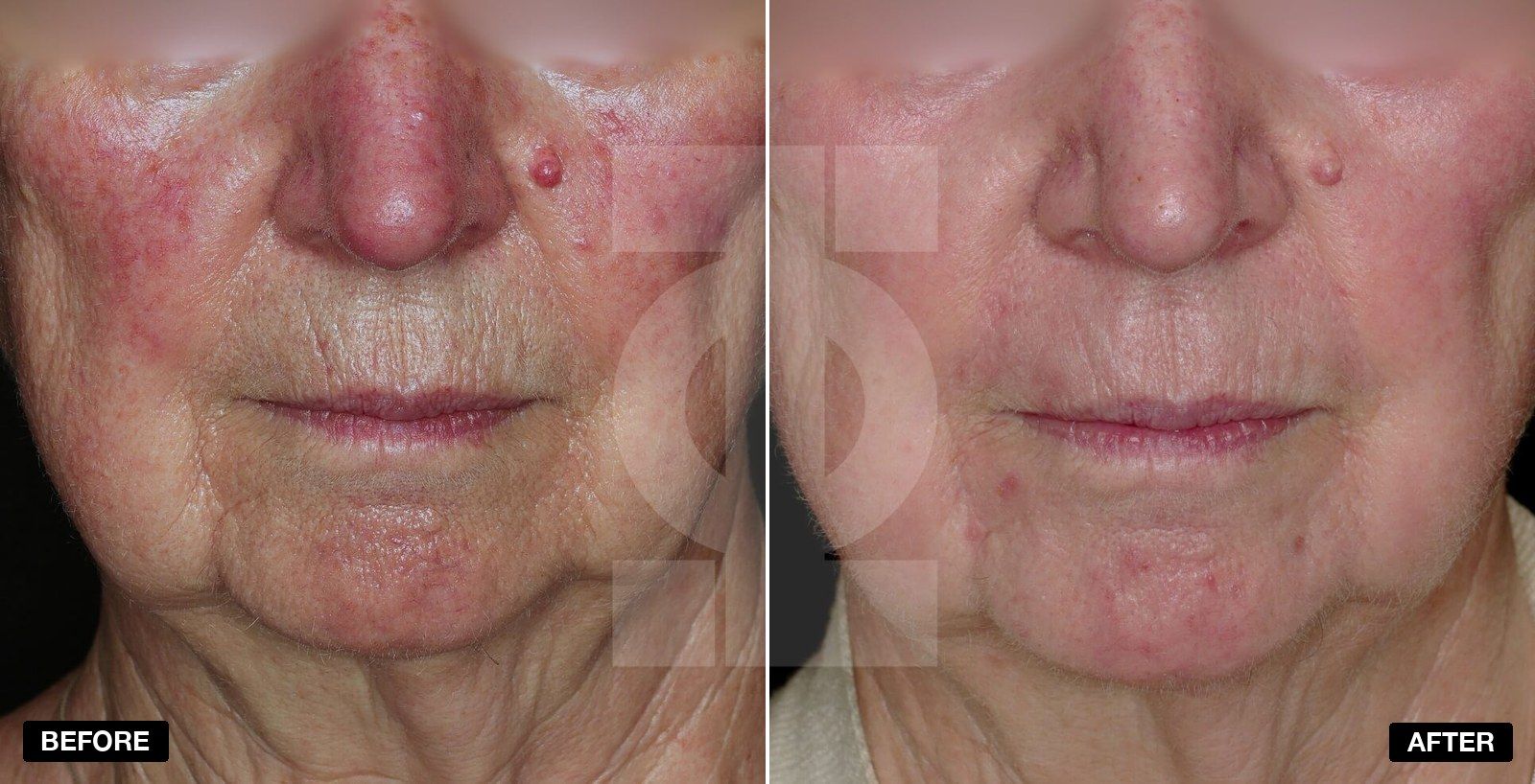 Laser resurfacing before and afters - patient case 3 of 4 at PHI Clinic London