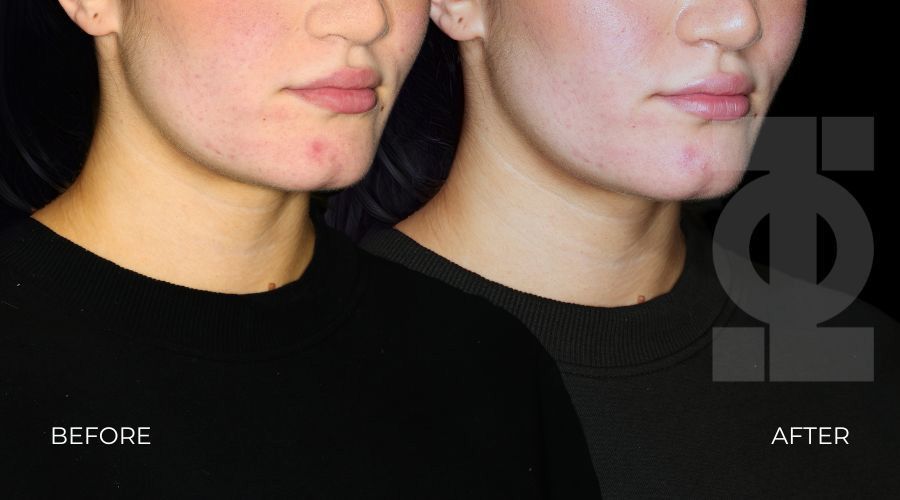 lip filler before and after treatment london