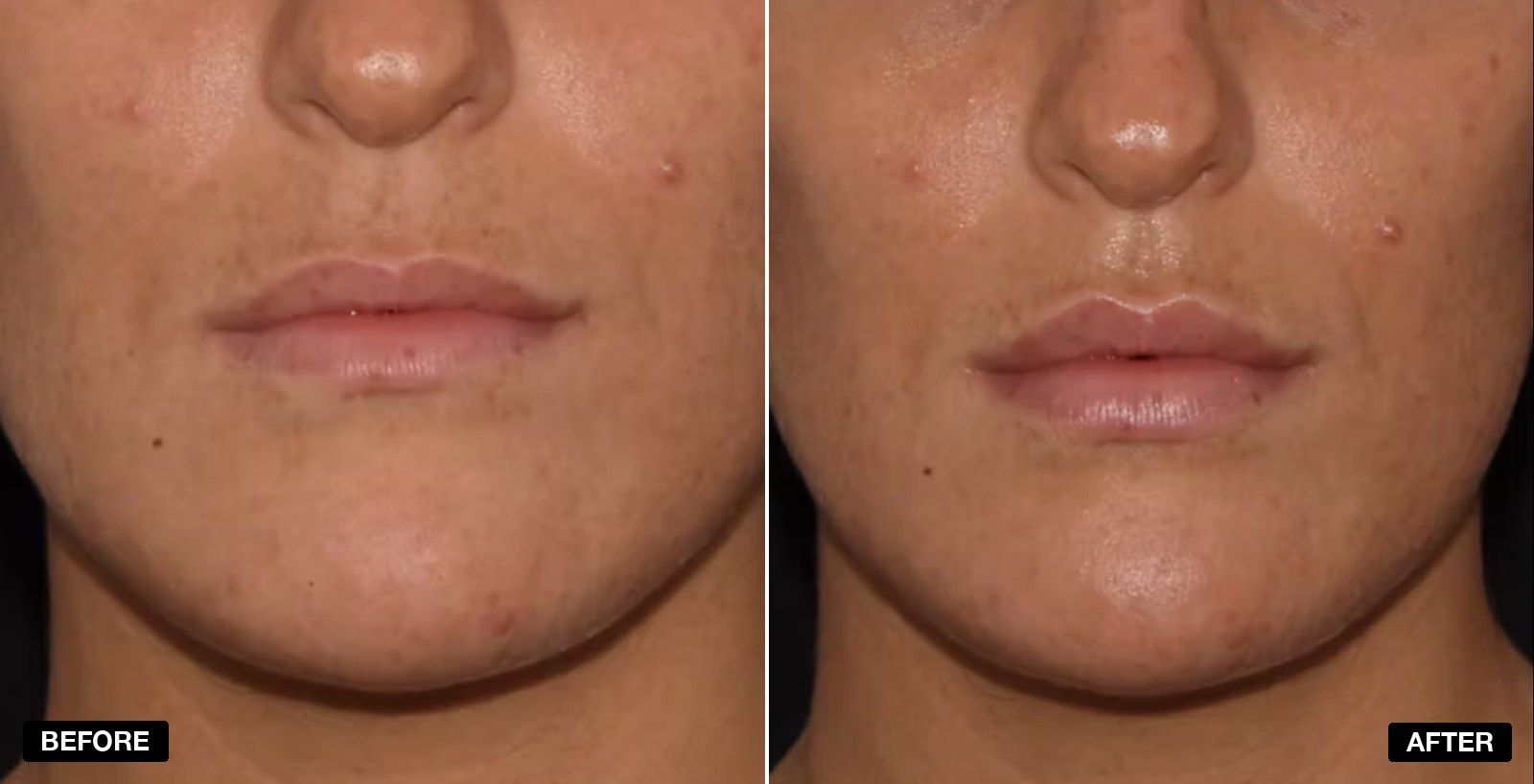 Lip Fillers Before & After Images - patient case 1 of 1 at PHI Clinic London