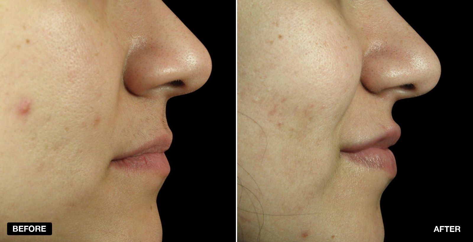 Lip fillers before and after Images - patient case 3 of 11 at PHI Clinic London