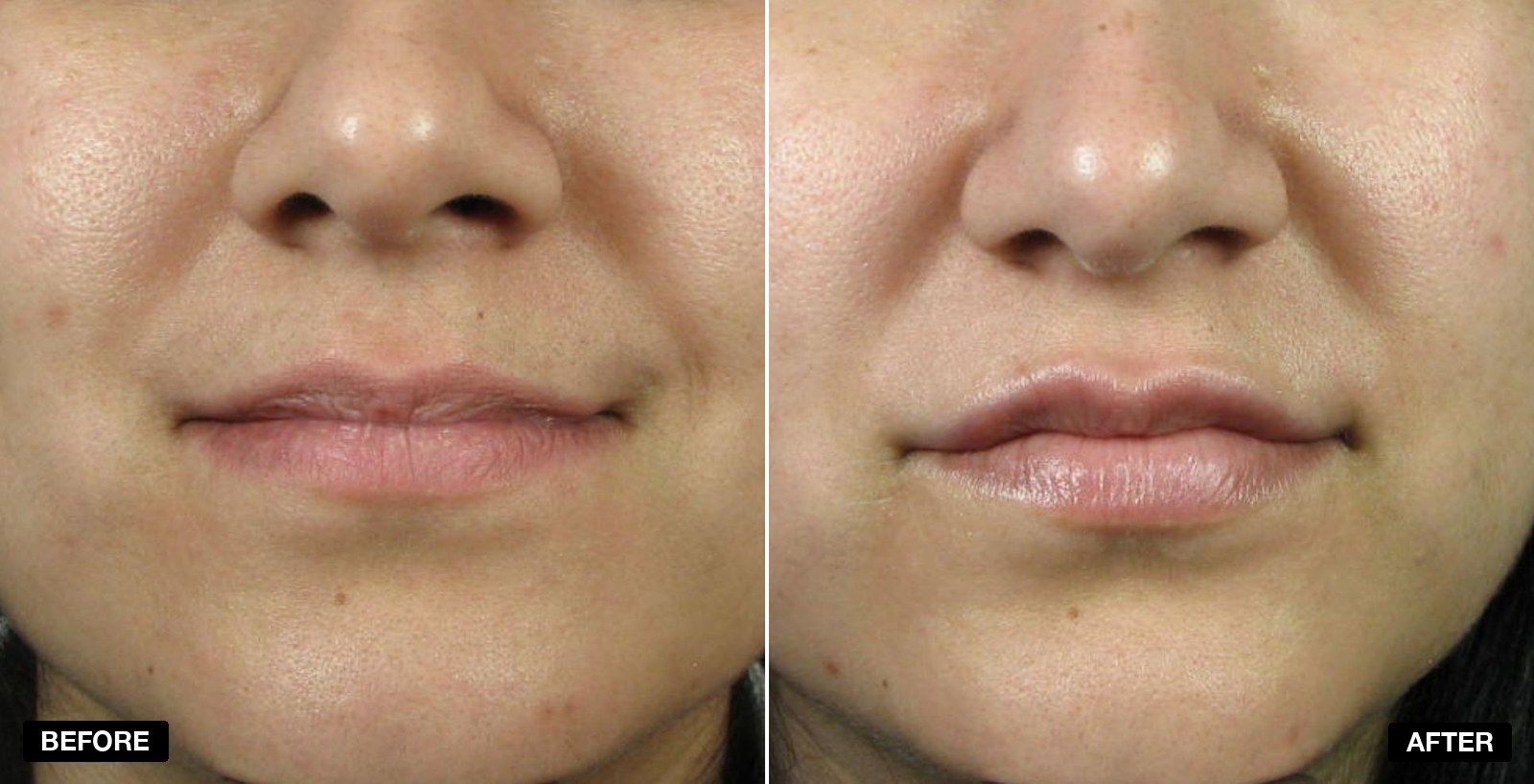 Lip fillers before and after Images - patient case 4 of 11 at PHI Clinic London