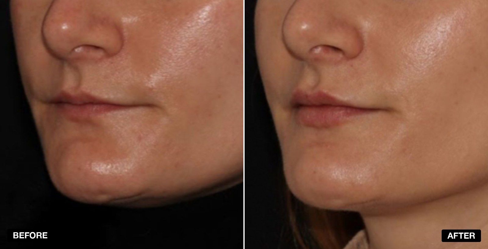 Lip fillers before and after Images - patient case 6 of 11 at PHI Clinic London