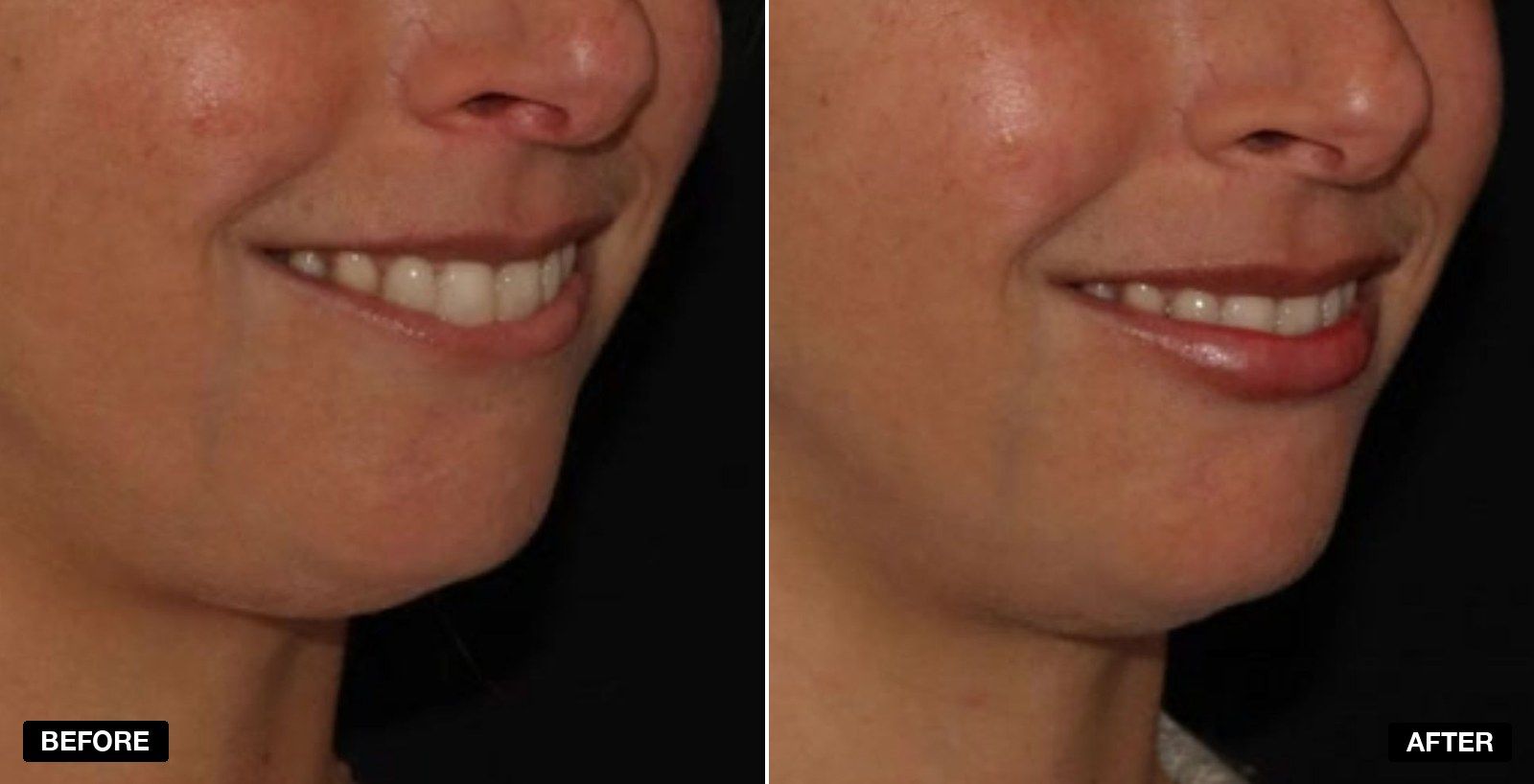 Lip fillers before and after Images - patient case 7 of 11 at PHI Clinic London