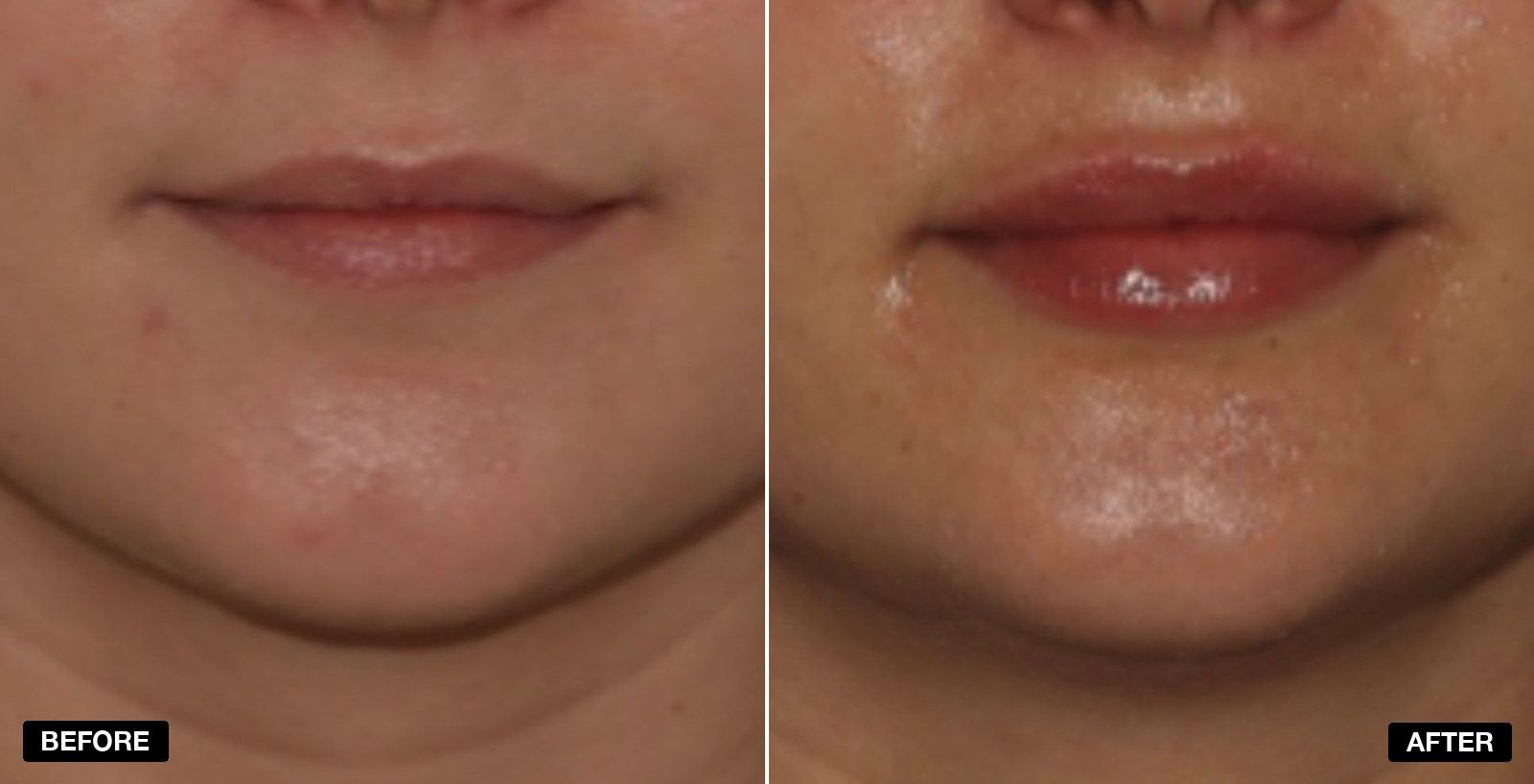 Lip fillers before and after Images - patient case 8 of 11 at PHI Clinic London