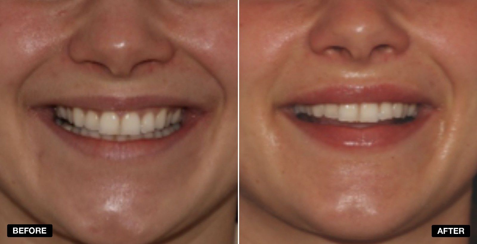 Lip fillers before and after Images - patient case 9 of 11 at PHI Clinic London