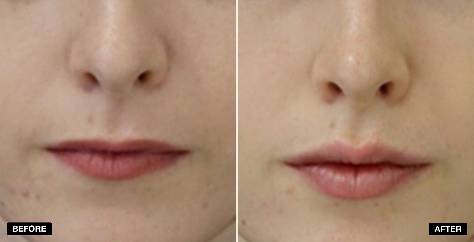 Lip fillers before and after Images - patient case 10 of 11 at PHI Clinic London