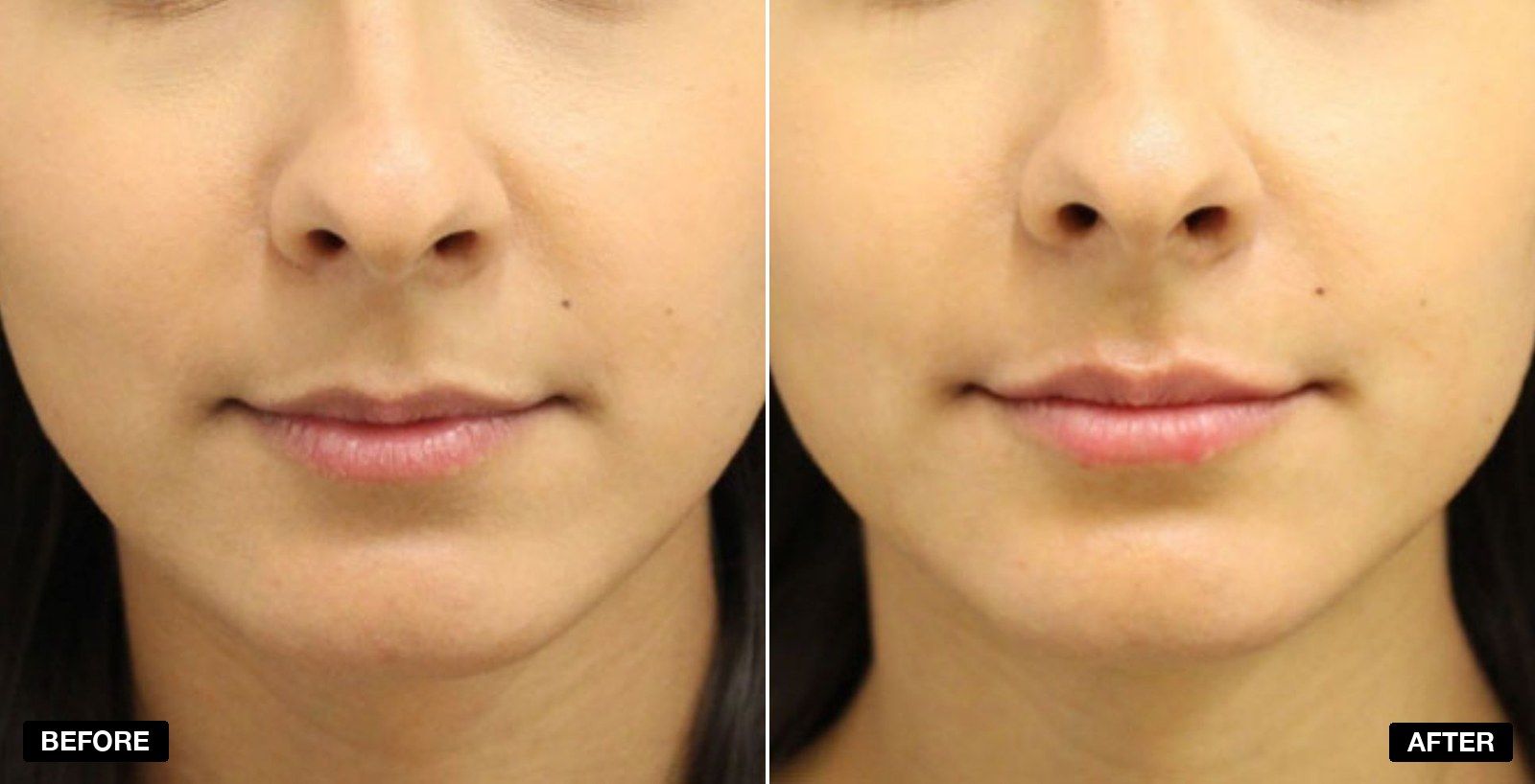 Lip fillers before and after Images - patient case 11 of 11 at PHI Clinic London