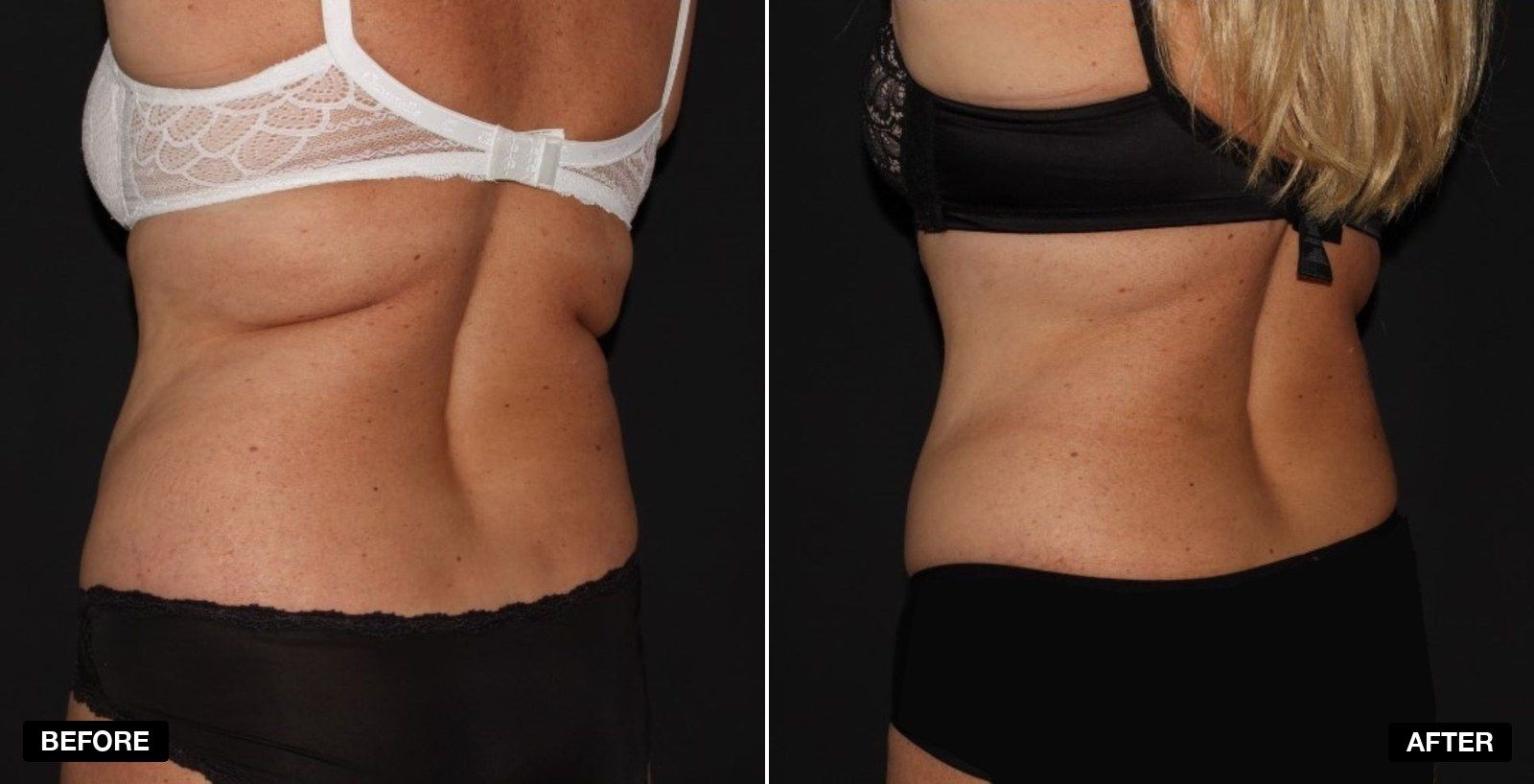 Love Handles transformation - patient case 1 of 1 at PHI Clinic London