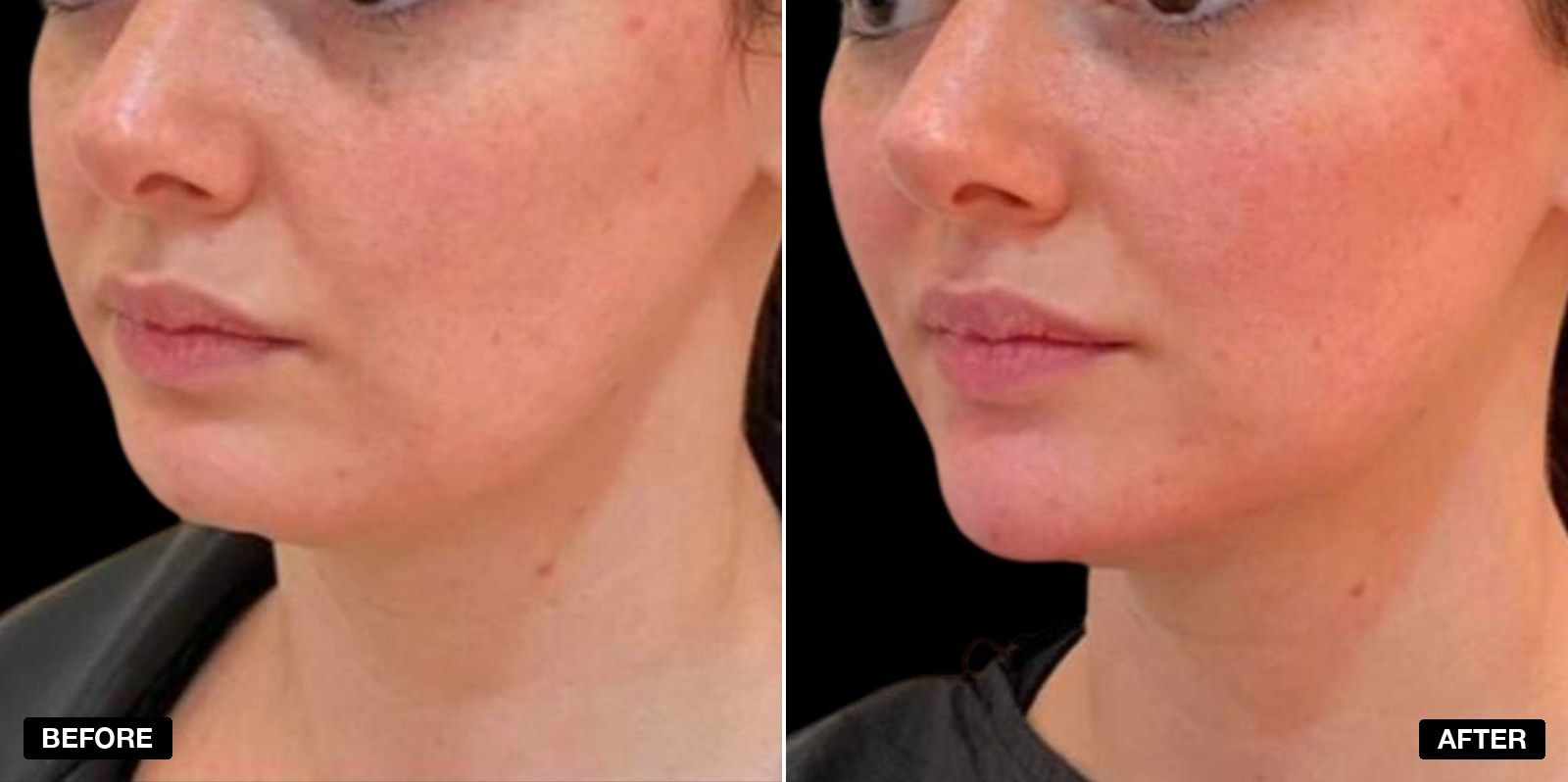 Masseter (Jawline Slimming) Botox before and after  - patient case 1 of 3 at PHI Clinic London