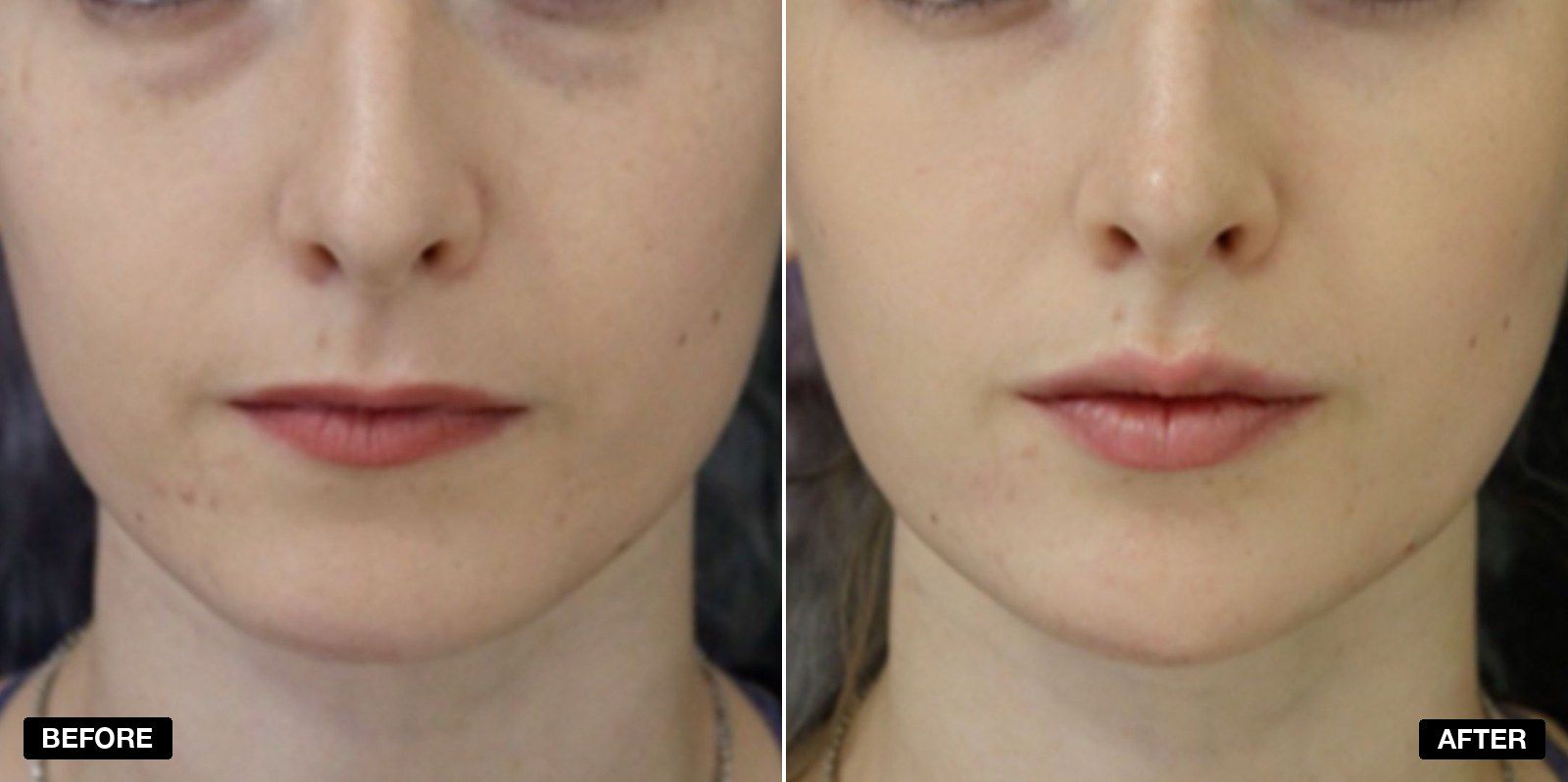 Masseter (Jawline Slimming) Botox before and after  - patient case 2 of 3 at PHI Clinic London