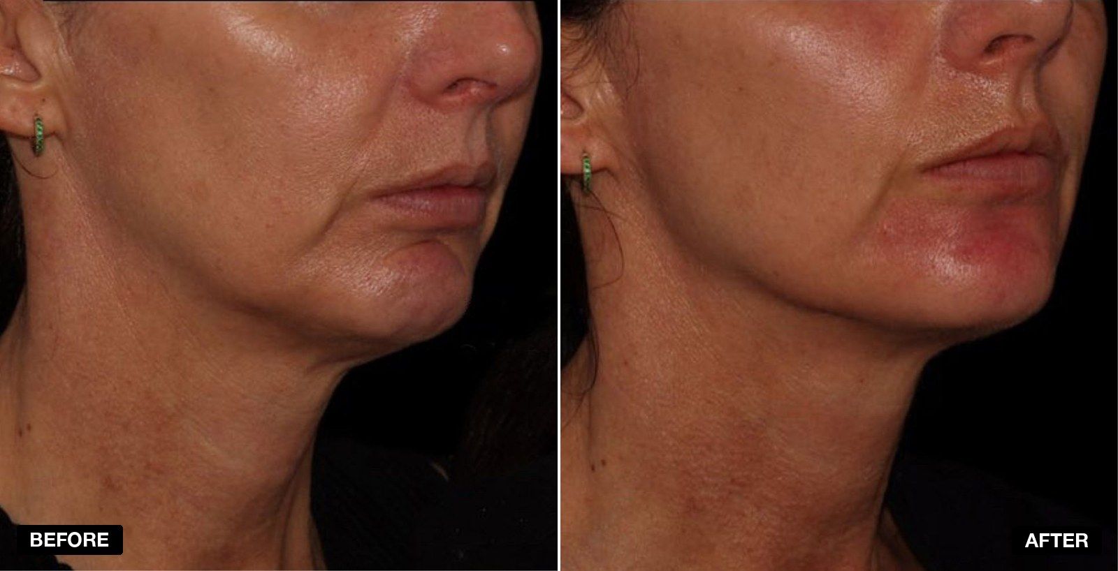 Masseter (Jawline Slimming) Botox before and after  - patient case 3 of 3 at PHI Clinic London