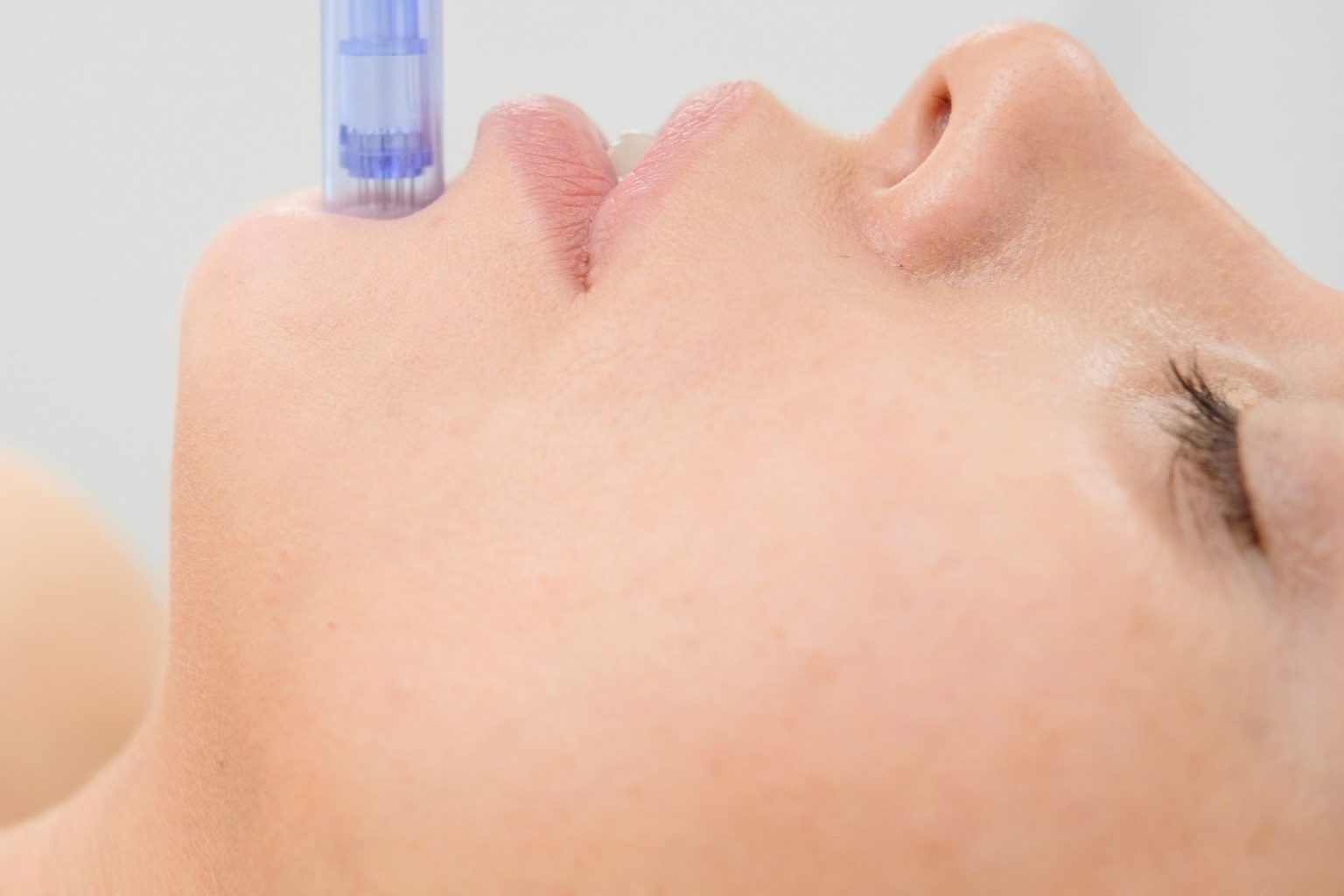 microneedling phi clinic london treatments