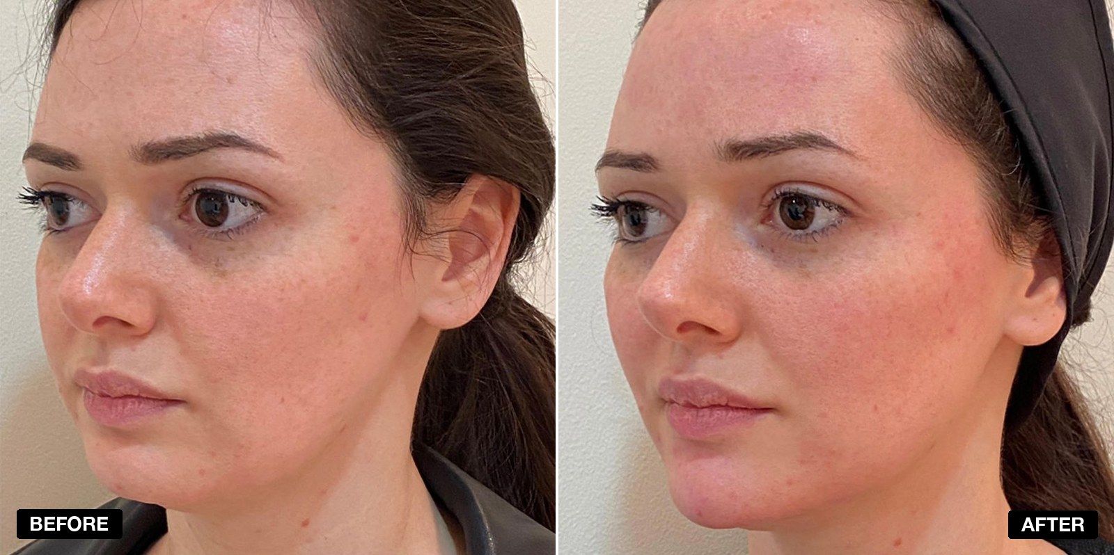 Non surgical facelift before and after images - patient case 2 of 8 at PHI Clinic London
