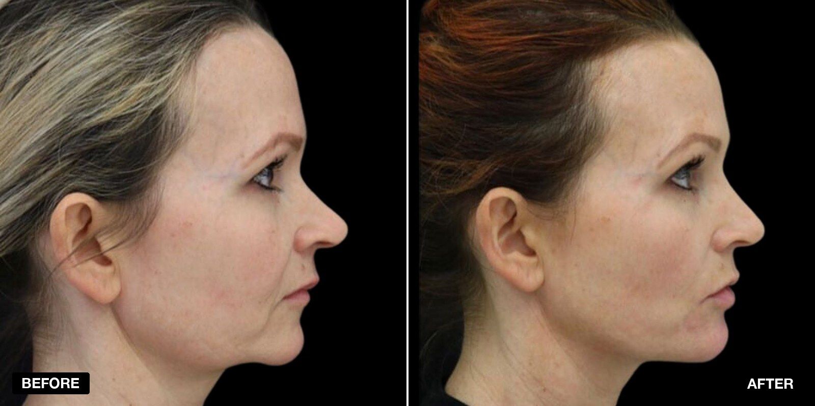 Non surgical facelift before and after images - patient case 4 of 8 at PHI Clinic London